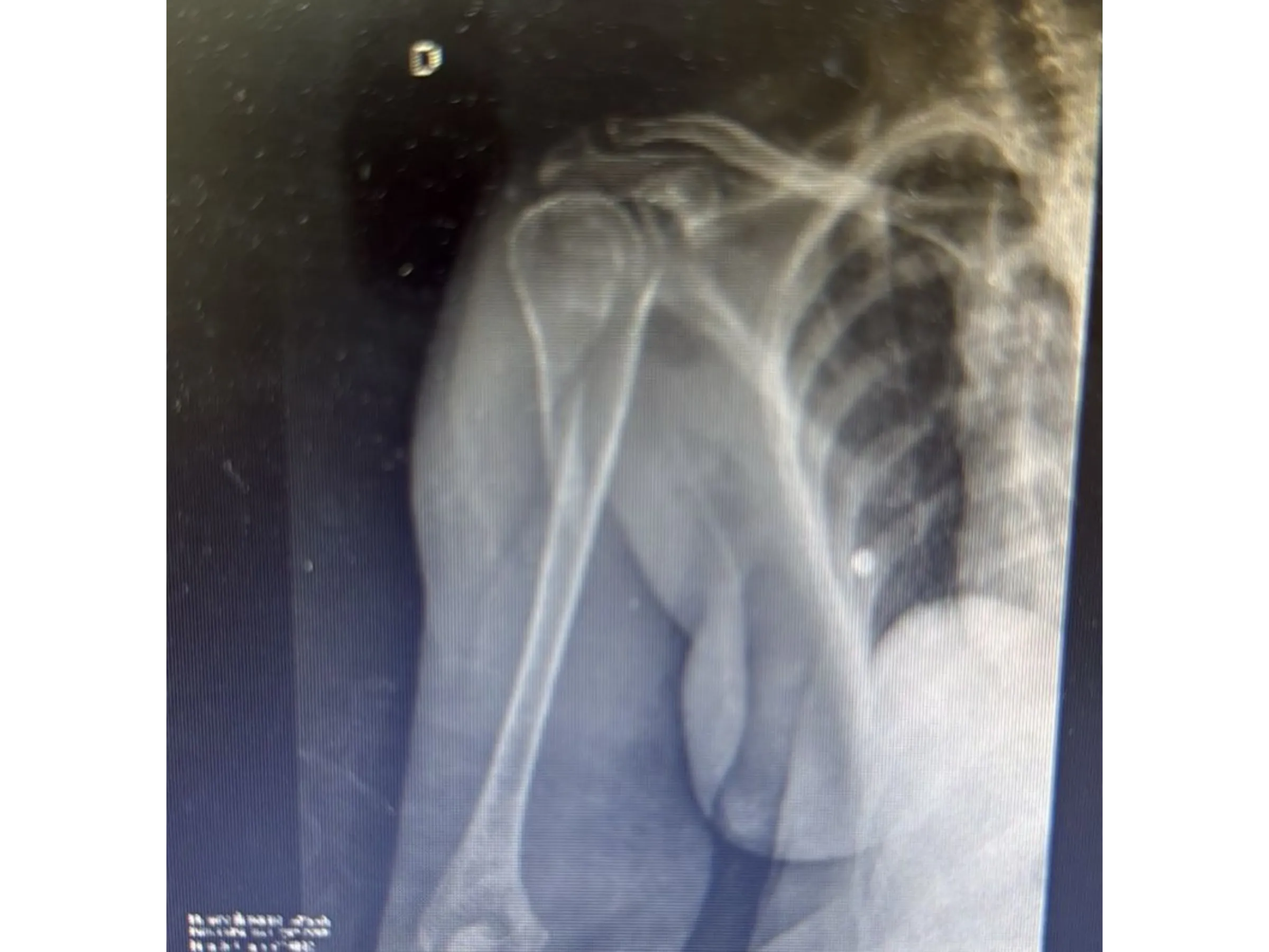 Intramedullärer Nagel für den proximalen Humerus