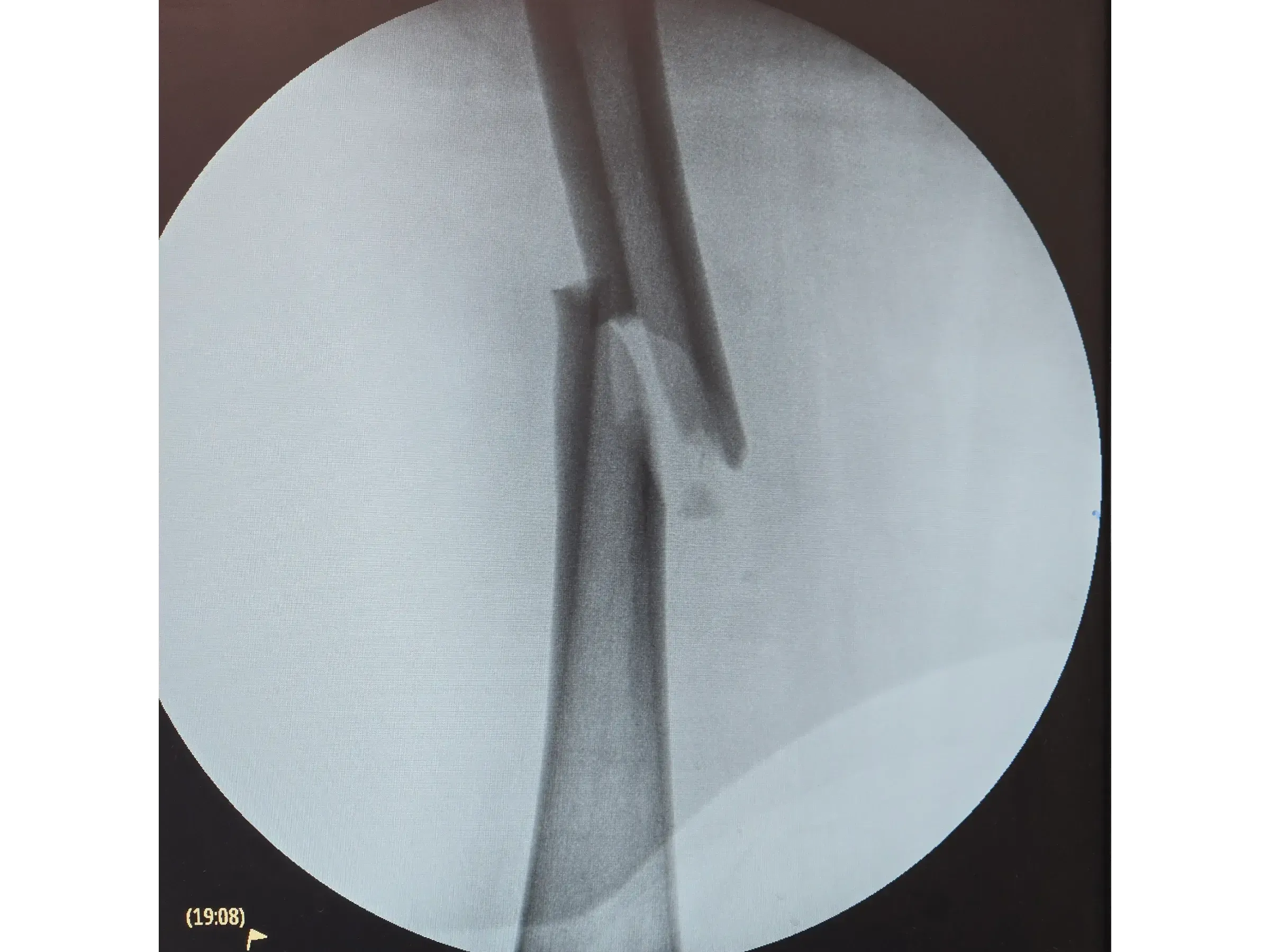 FEMORAL SHAFT [Case 2] · Retrograde Intramedullary Nail