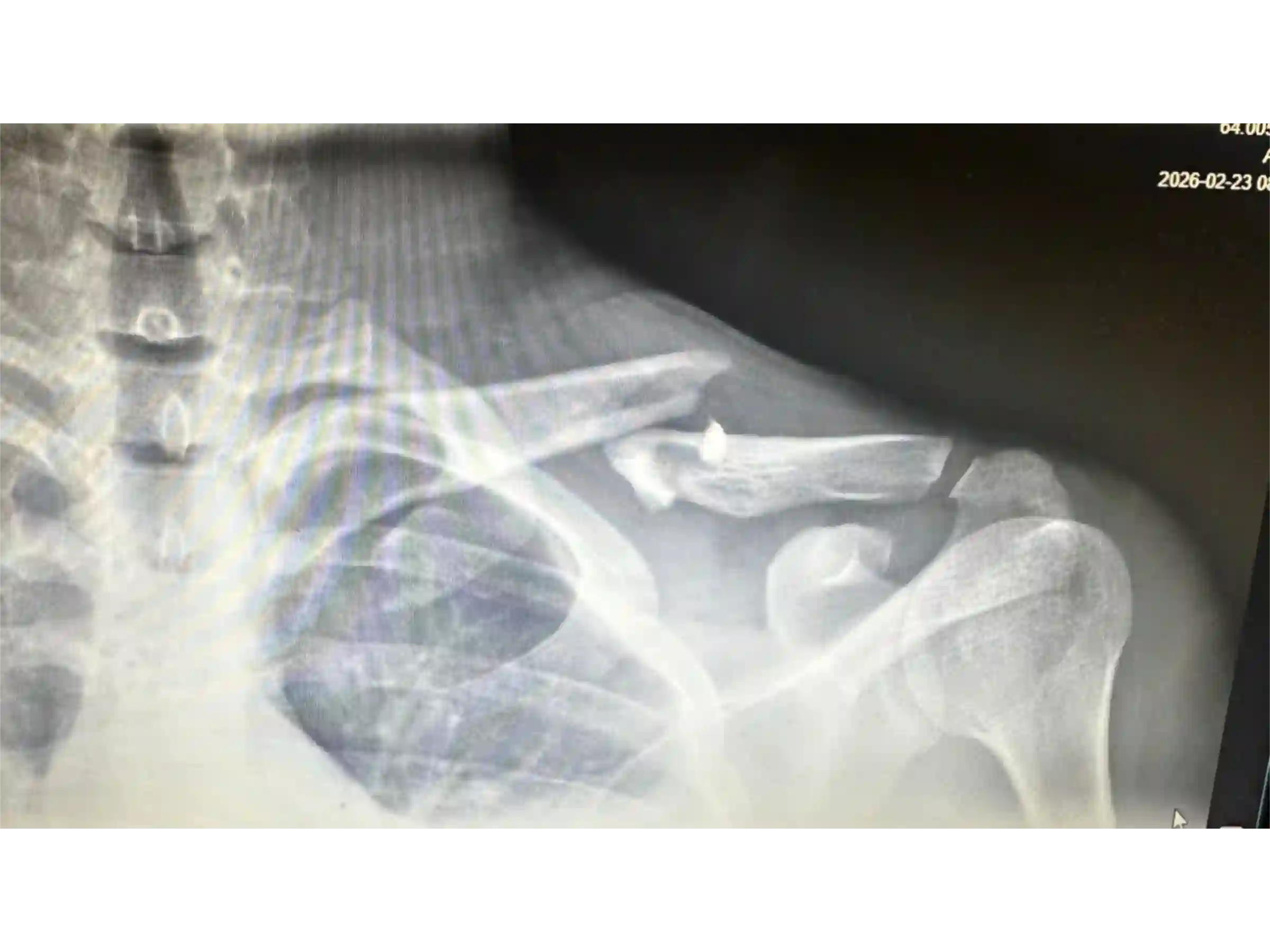 CLAVICLE [CASE 03] Minimally Invasive Percutaneous Osteosynthesis