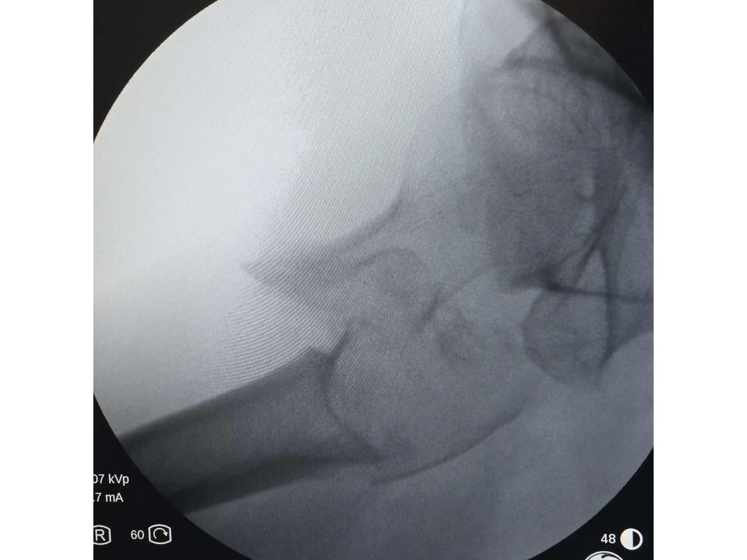 PROXIMALER FEMUR [Fall 4] · Doppel-Wippen-Technik