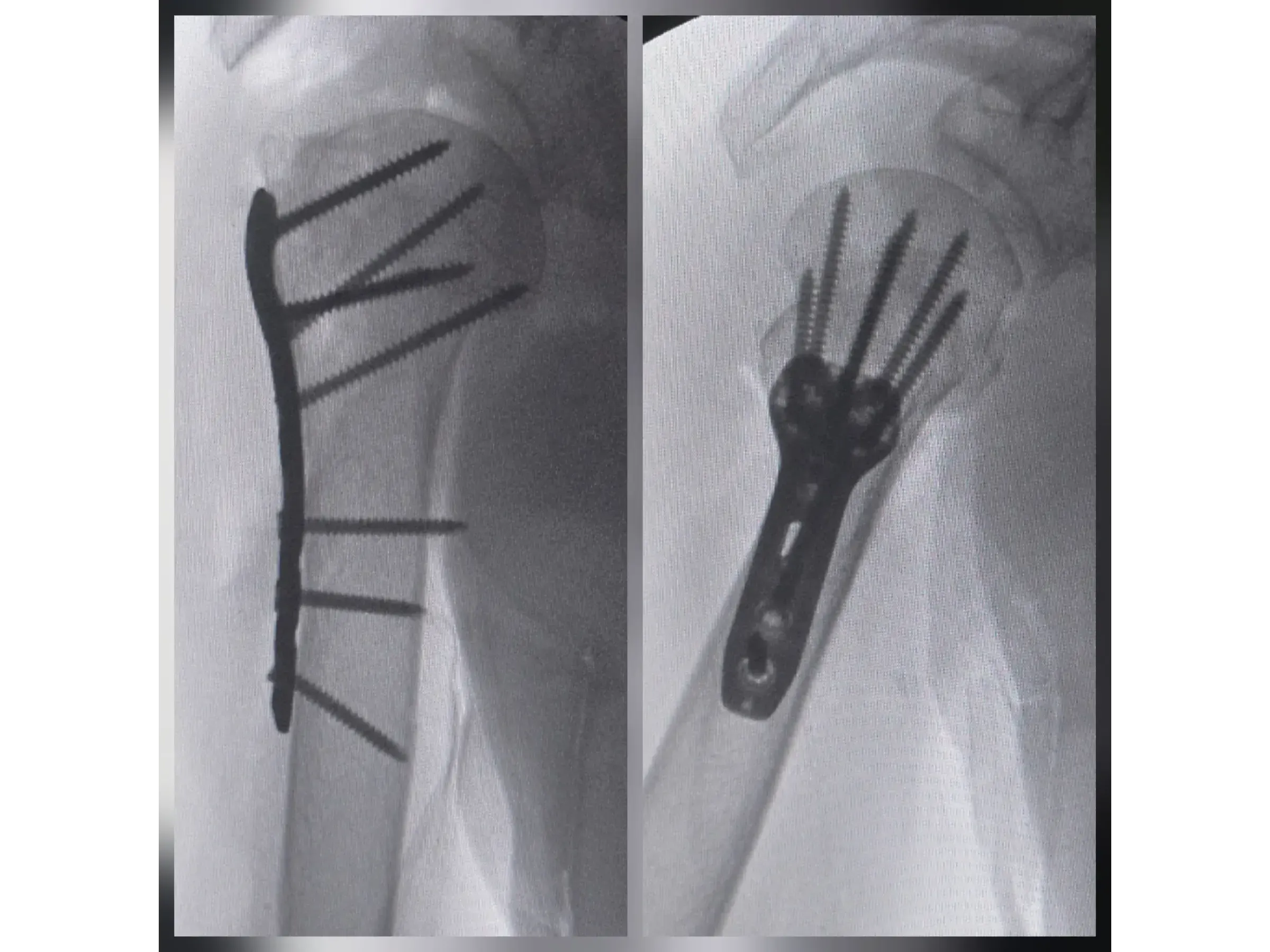 PROXIMAL HUMERUS [Case 6] · Two-Part Fracture · Plate and Screws