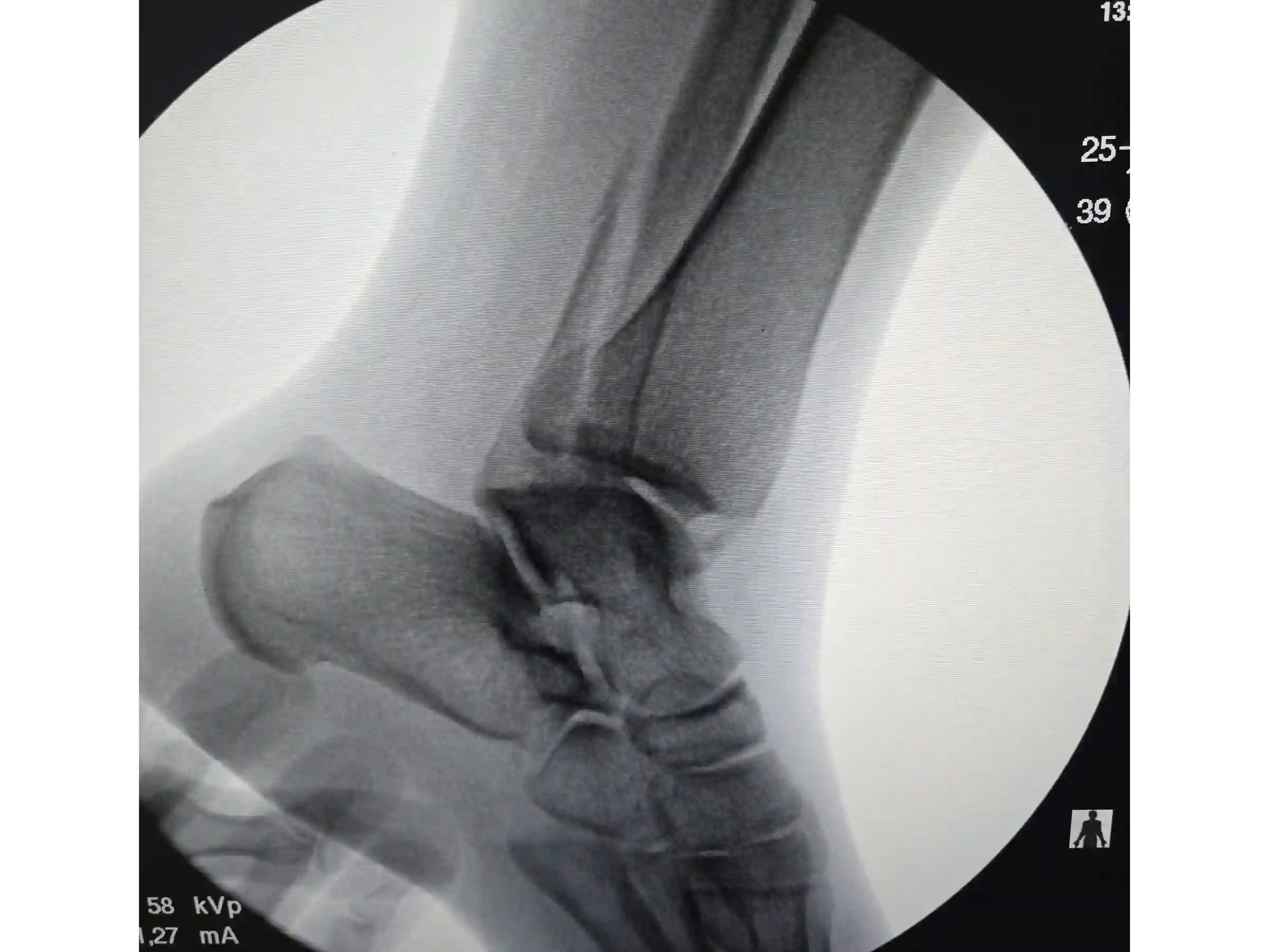 TRIMALLEOLAR [CASE 03] POSTEROLATERAL APPROACH + ANTEGRADE MEDIAL MALLEOLUS FIXATION