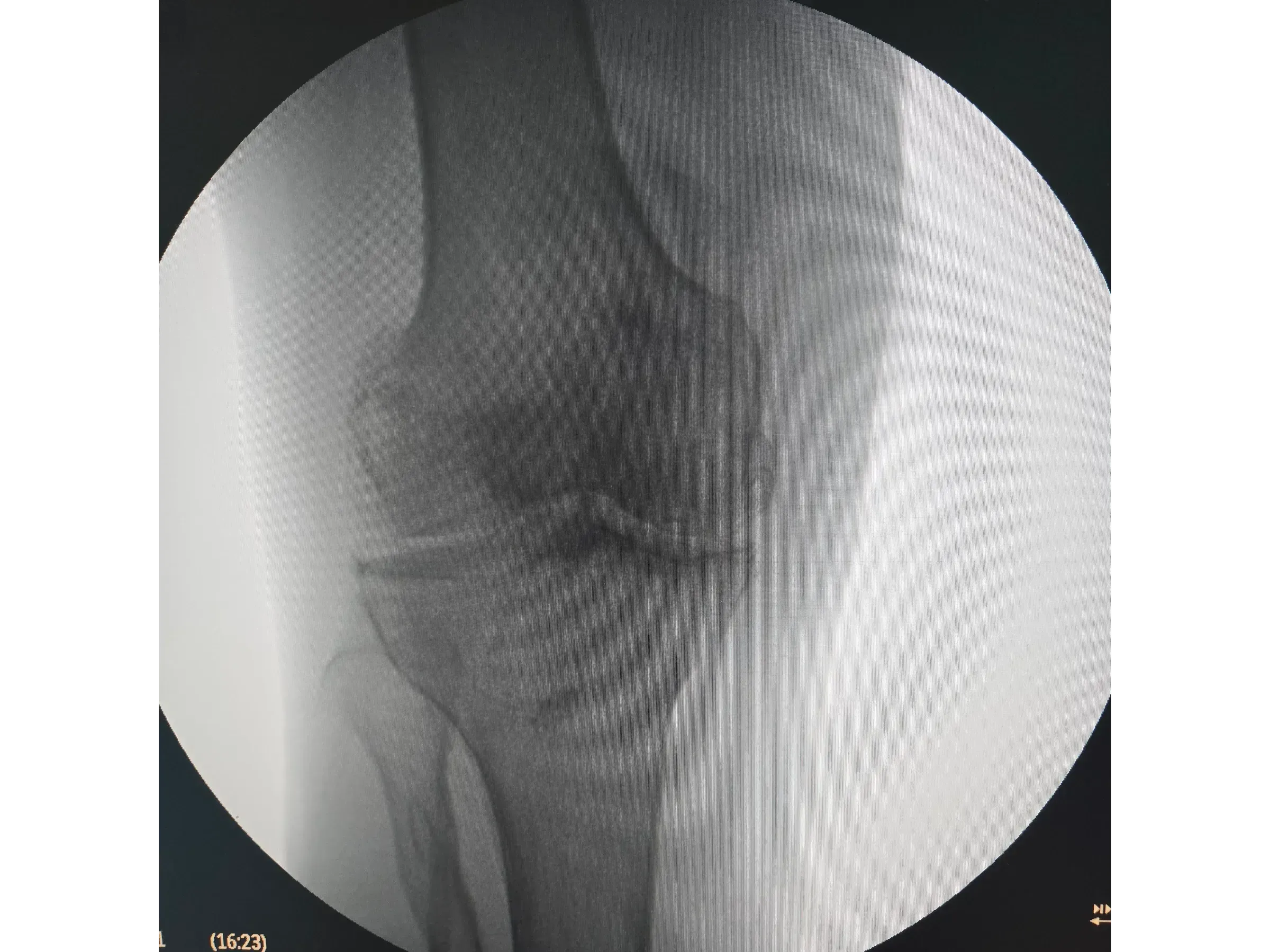 PATELLA [Case 2] · Cannulated Screws + Cerclage