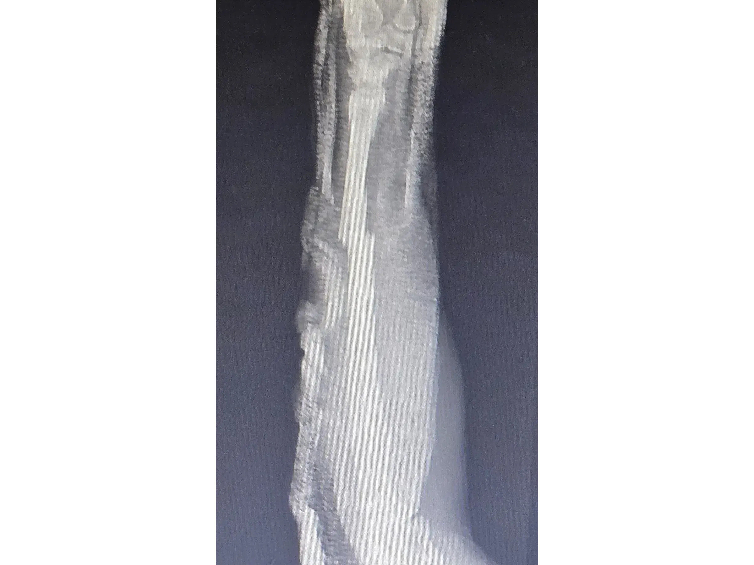 RADIAL SHAFT [Case 2] · Thompson Approach