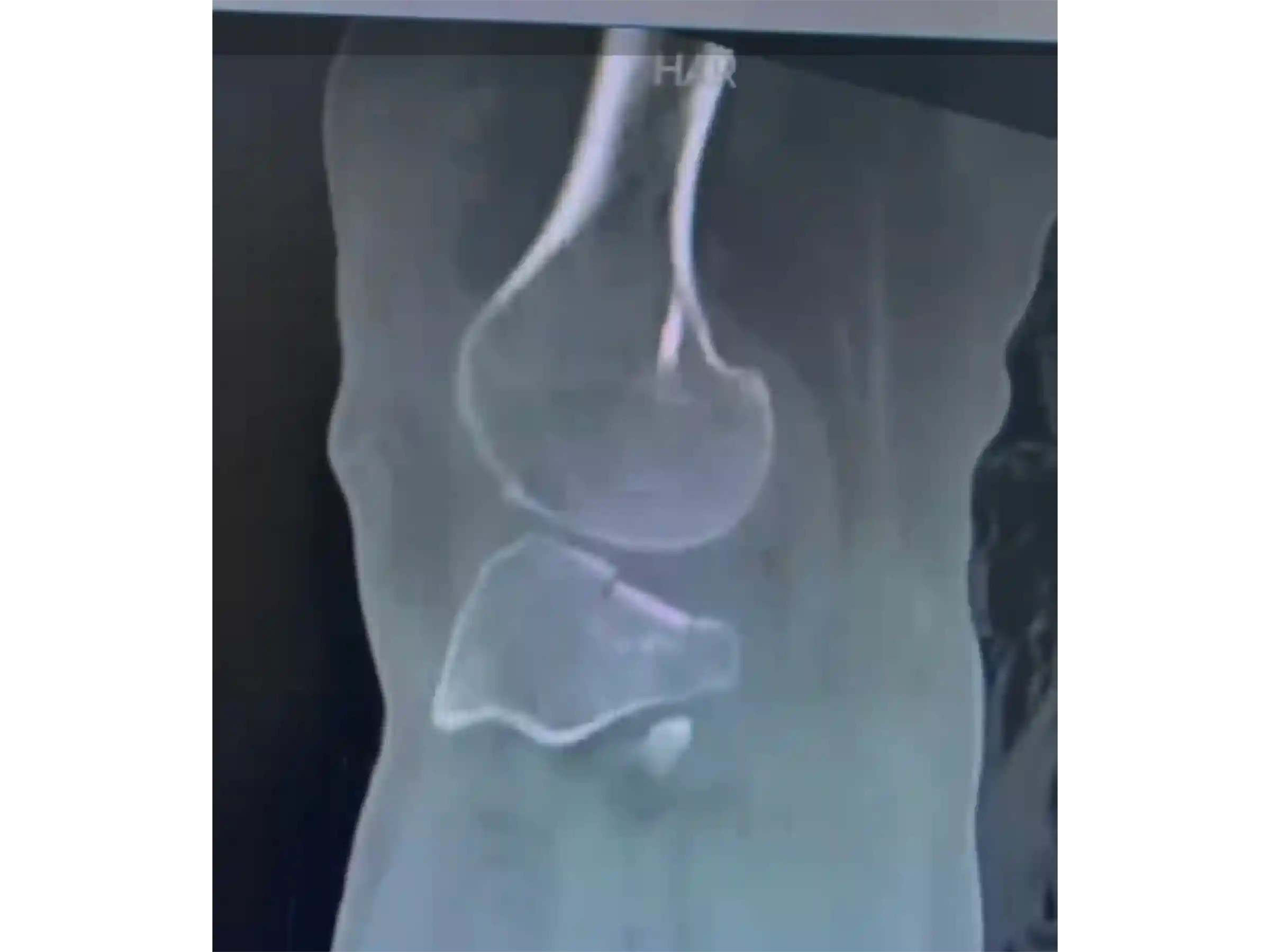 TIBIAL PLATEAU [CASE 03] Posterolateral Depression