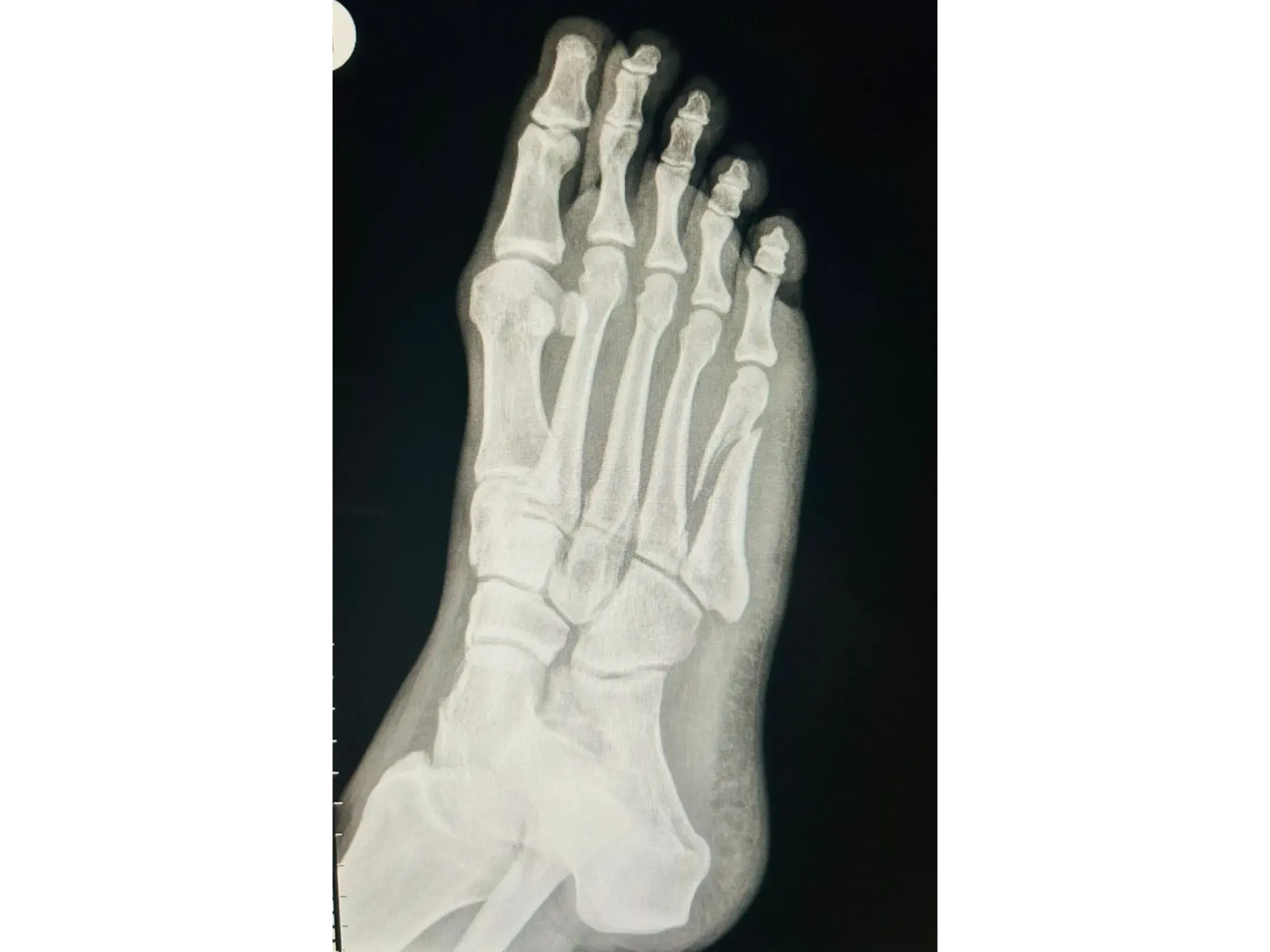 FIFTH METATARSAL [Case 2] · Mini-fragment Plate and Screws