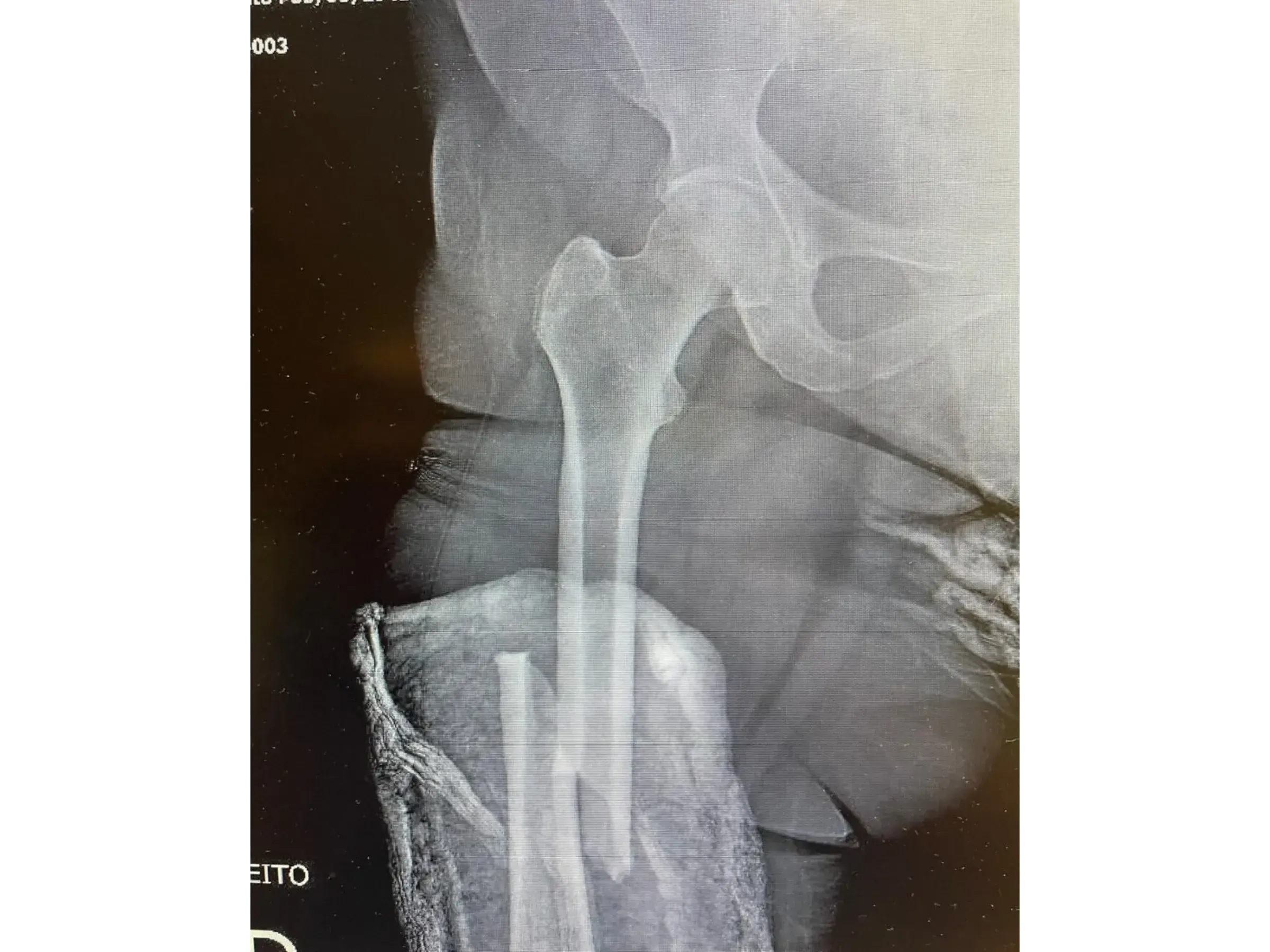 FEMORAL SHAFT [Case 2] · Retrograde Intramedullary Nail