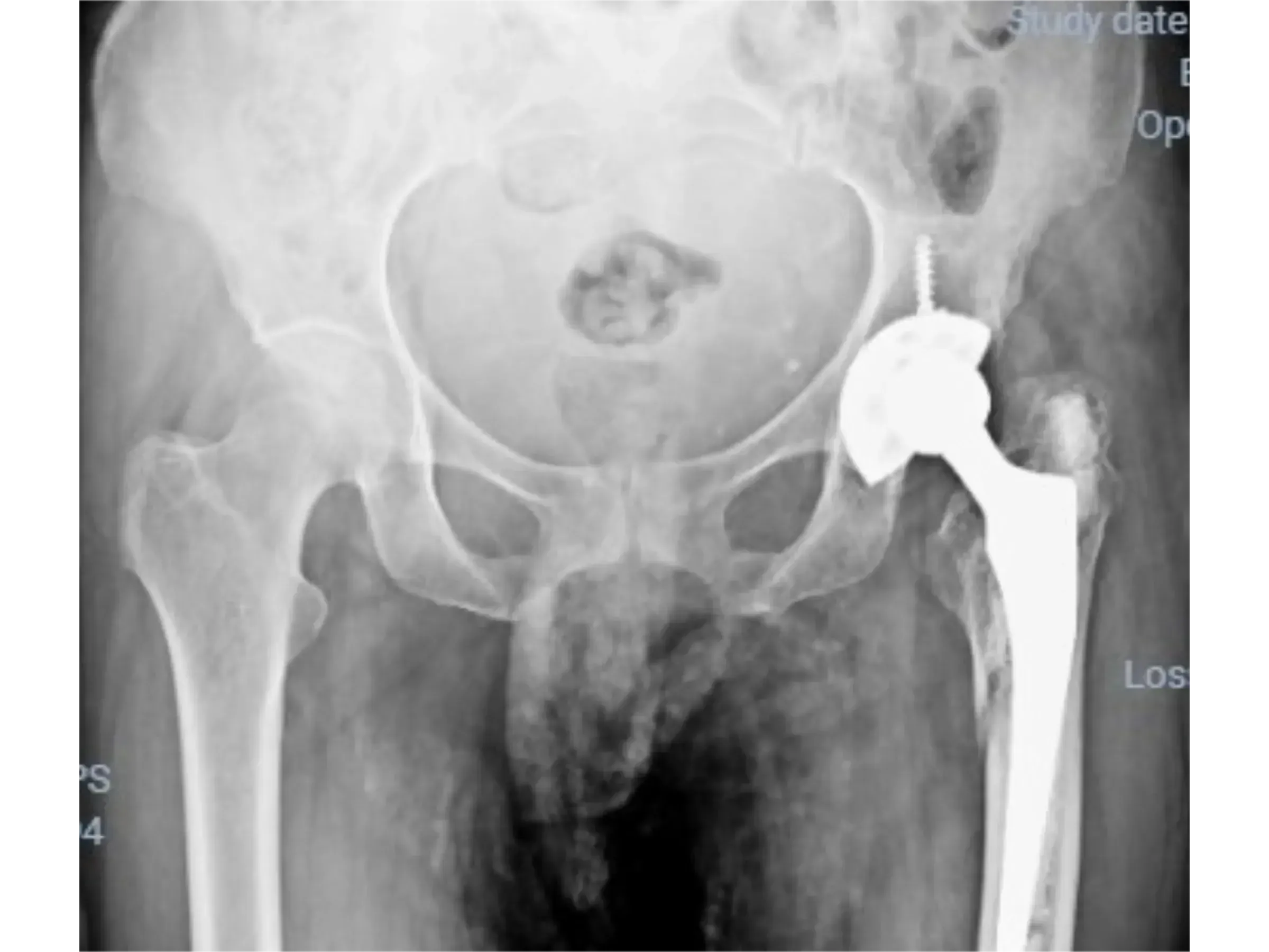 PERIPROSTHETIC HIP FRACTURE [Case 1] · Trochanteric Plate + Cerclage