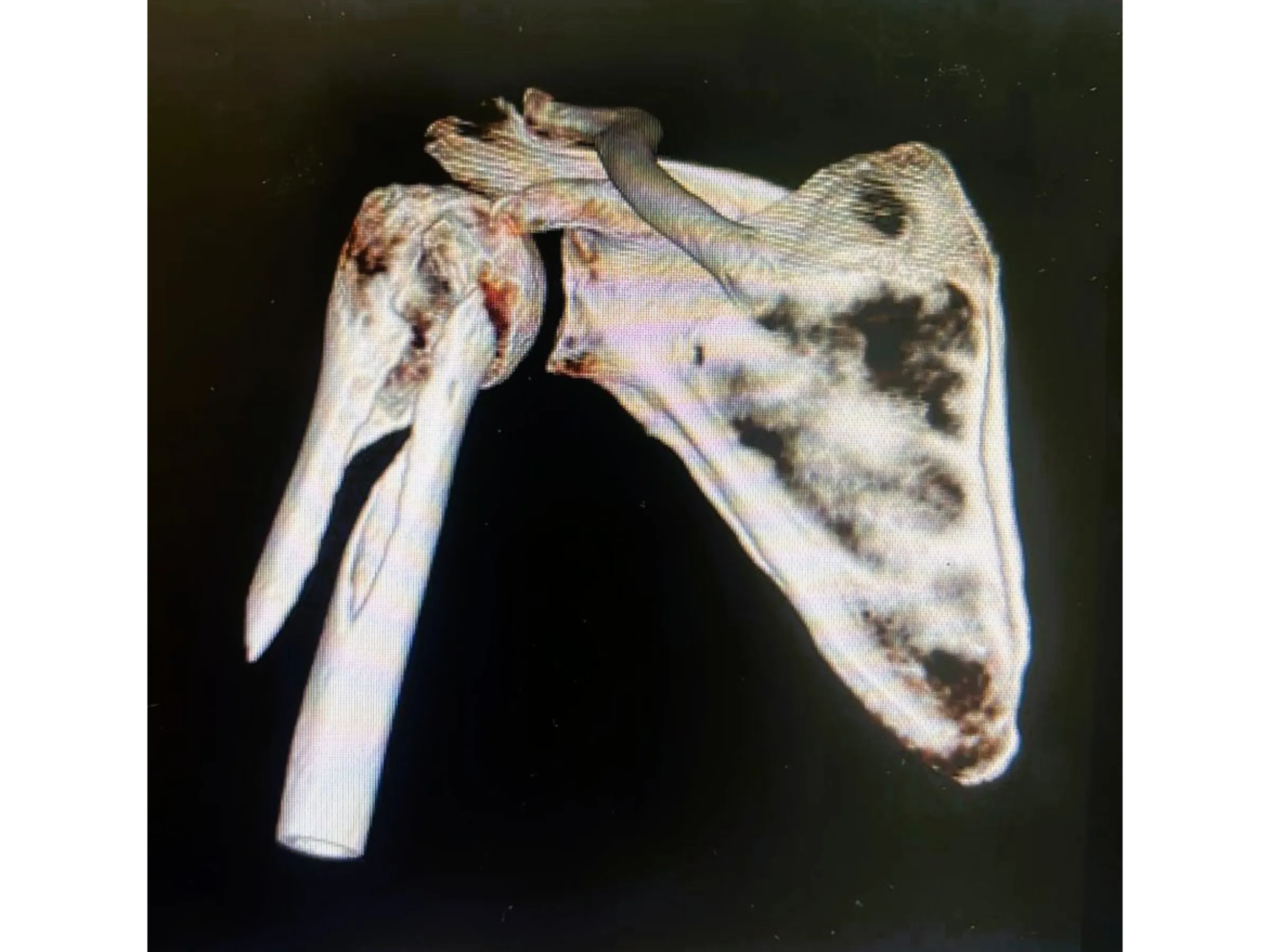 Intramedullärer Nagel für den proximalen Humerus