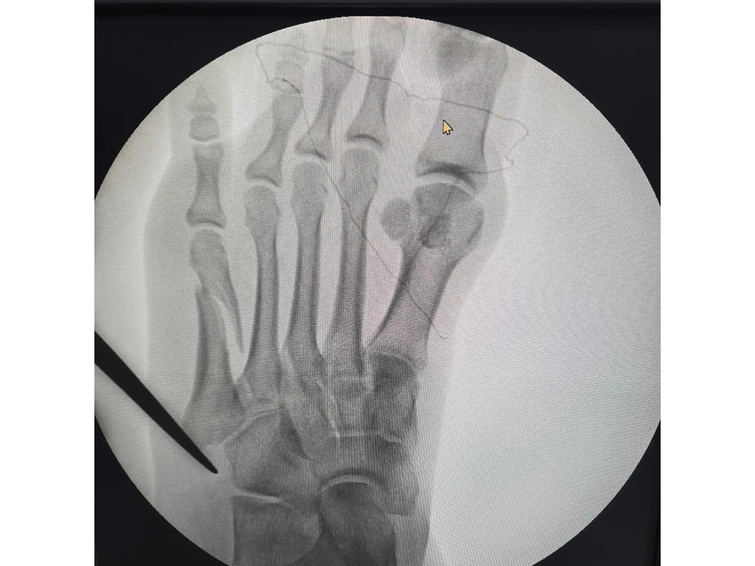 FIFTH METATARSAL [Case 2] · Mini-fragment Plate and Screws