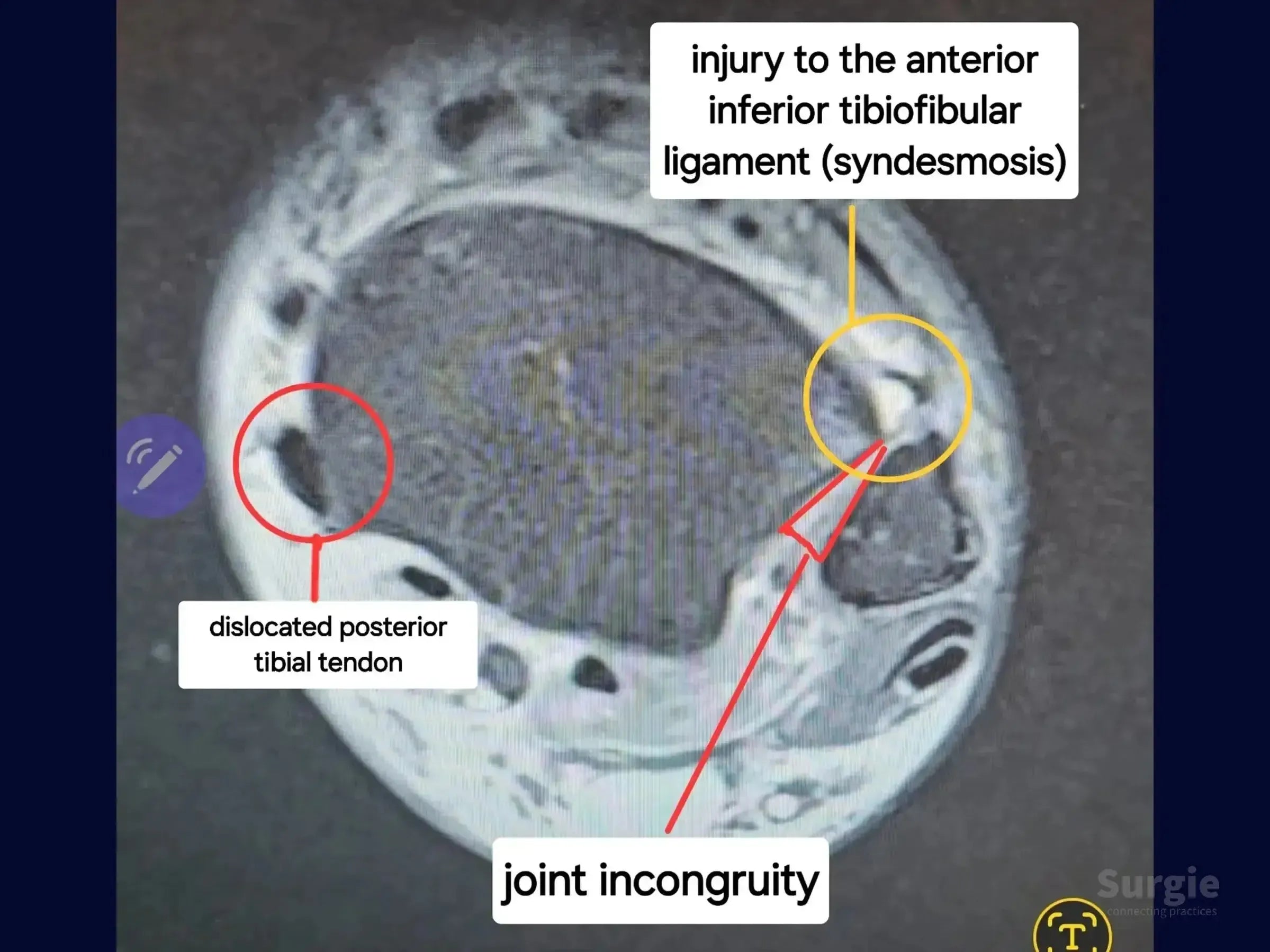 Ankle MRI cross-section highlighting syndesmosis ligament injury, dislocated posterior tibial tendon, and joint incongruity.