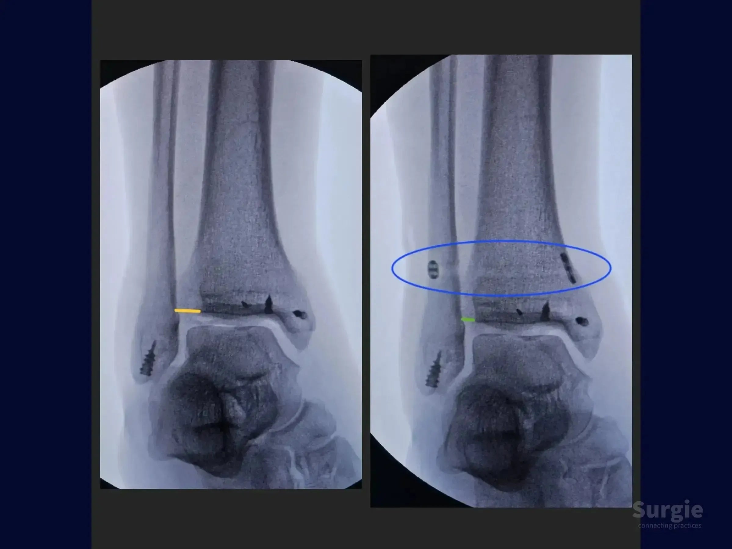 X-ray showing ankle reconstruction with surgical screws, suture anchors, and highlighted anatomical markers for ligament repair.