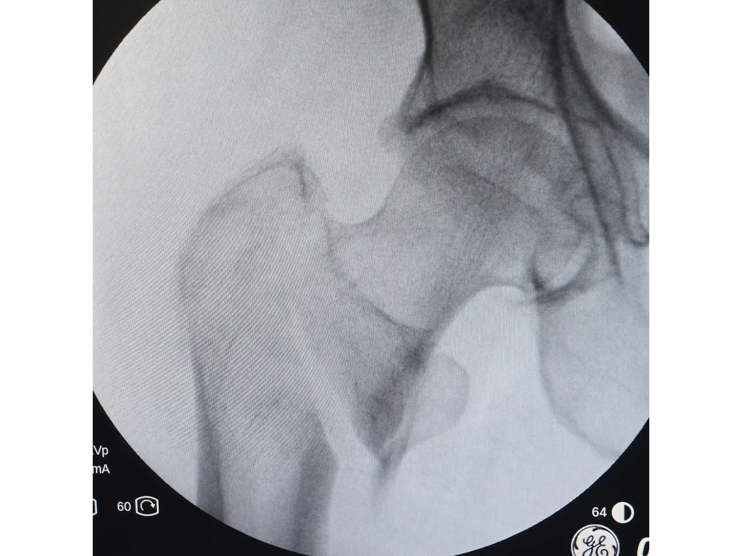 PROXIMALER FEMUR [Fall 4] · Doppel-Wippen-Technik
