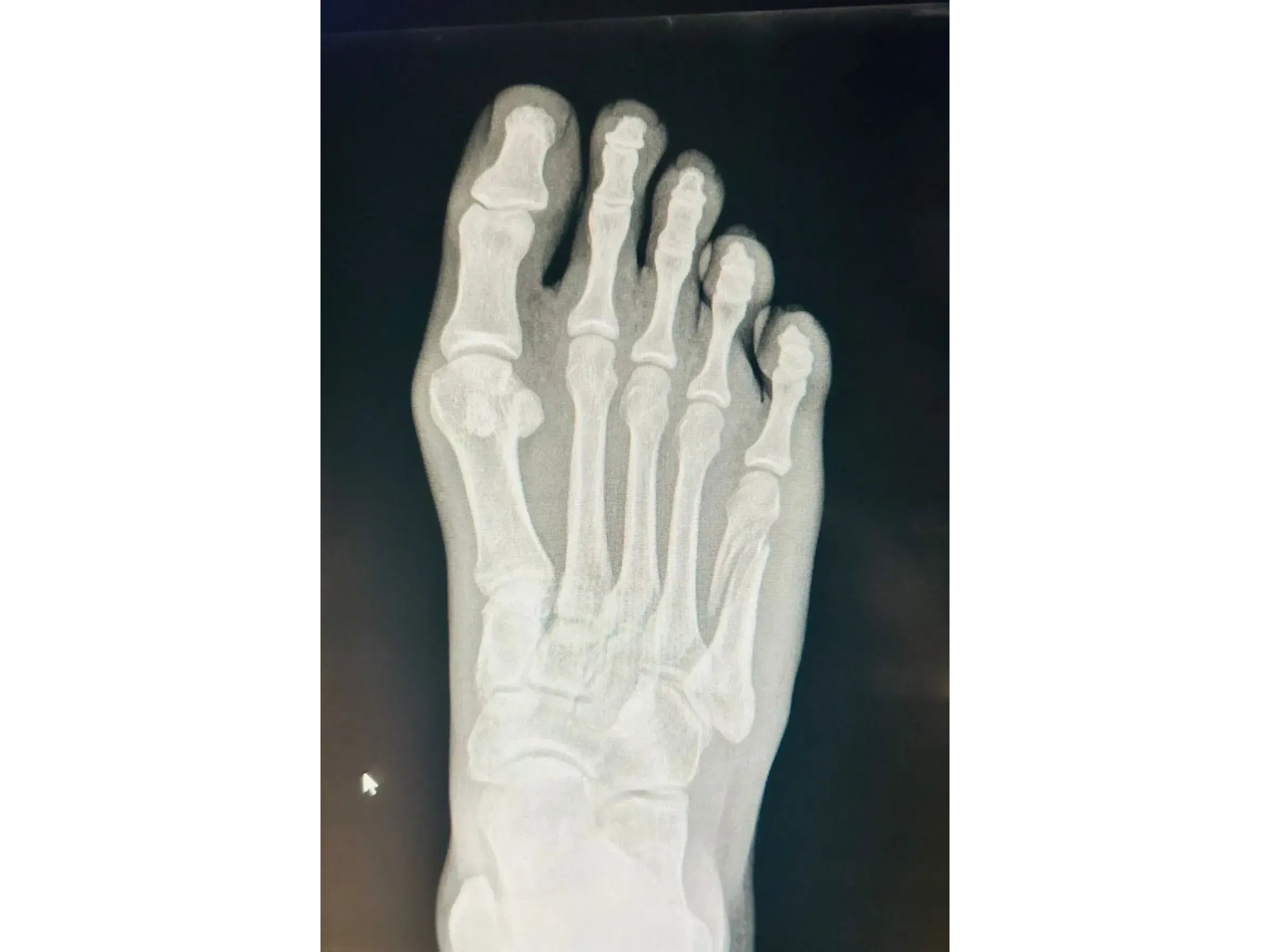 FIFTH METATARSAL [Case 2] · Mini-fragment Plate and Screws