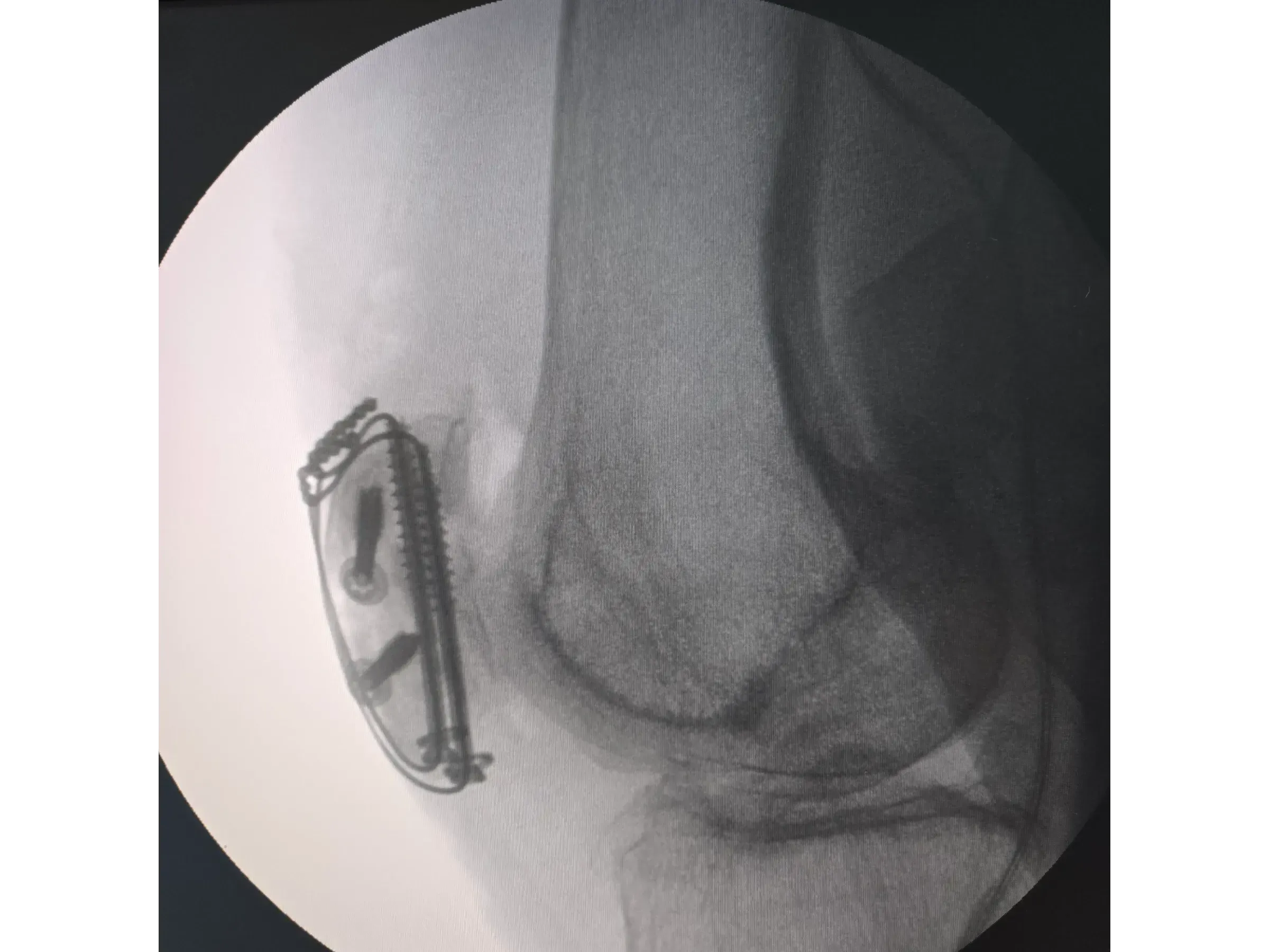 PATELLA [Case 2] · Cannulated Screws + Cerclage