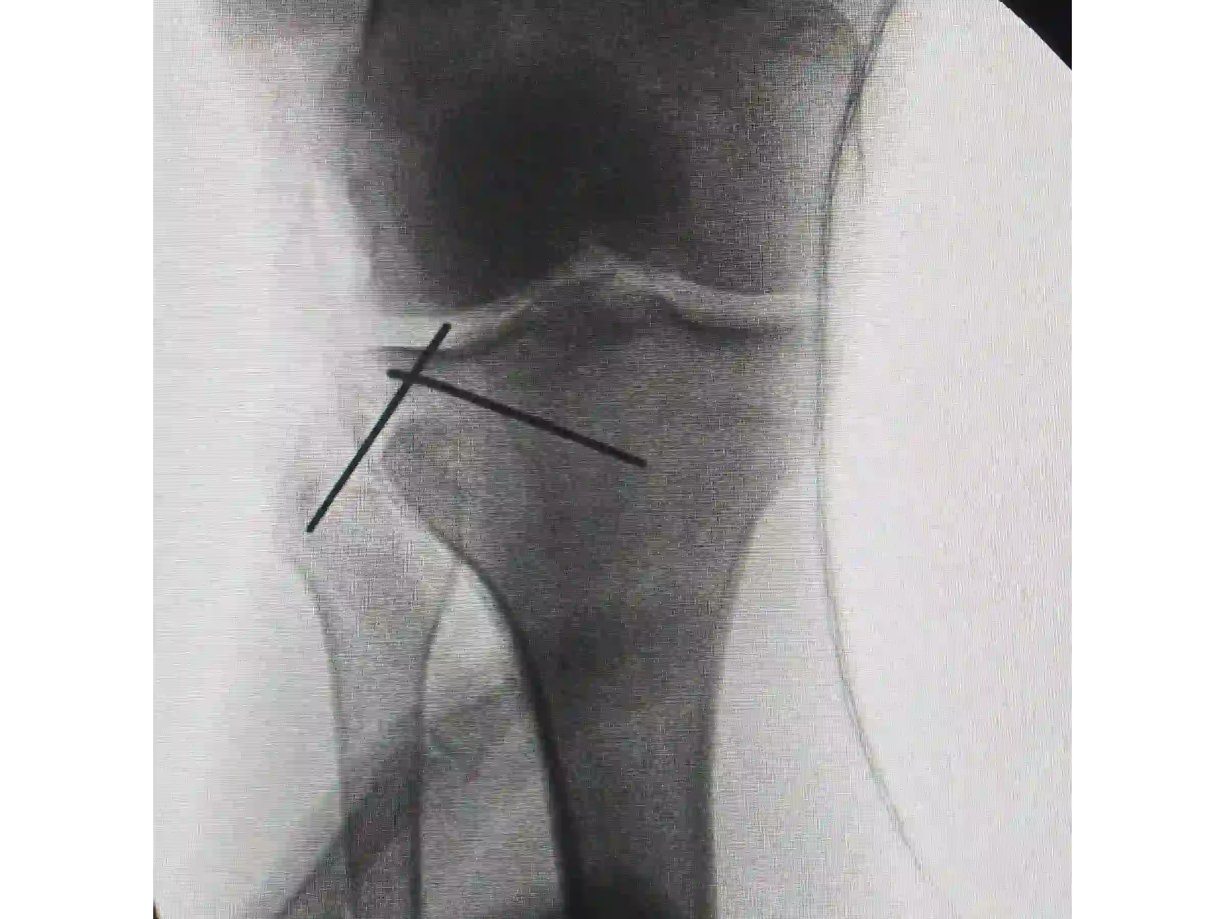 TIBIAL PLATEAU [CASE 03] Posterolateral Depression