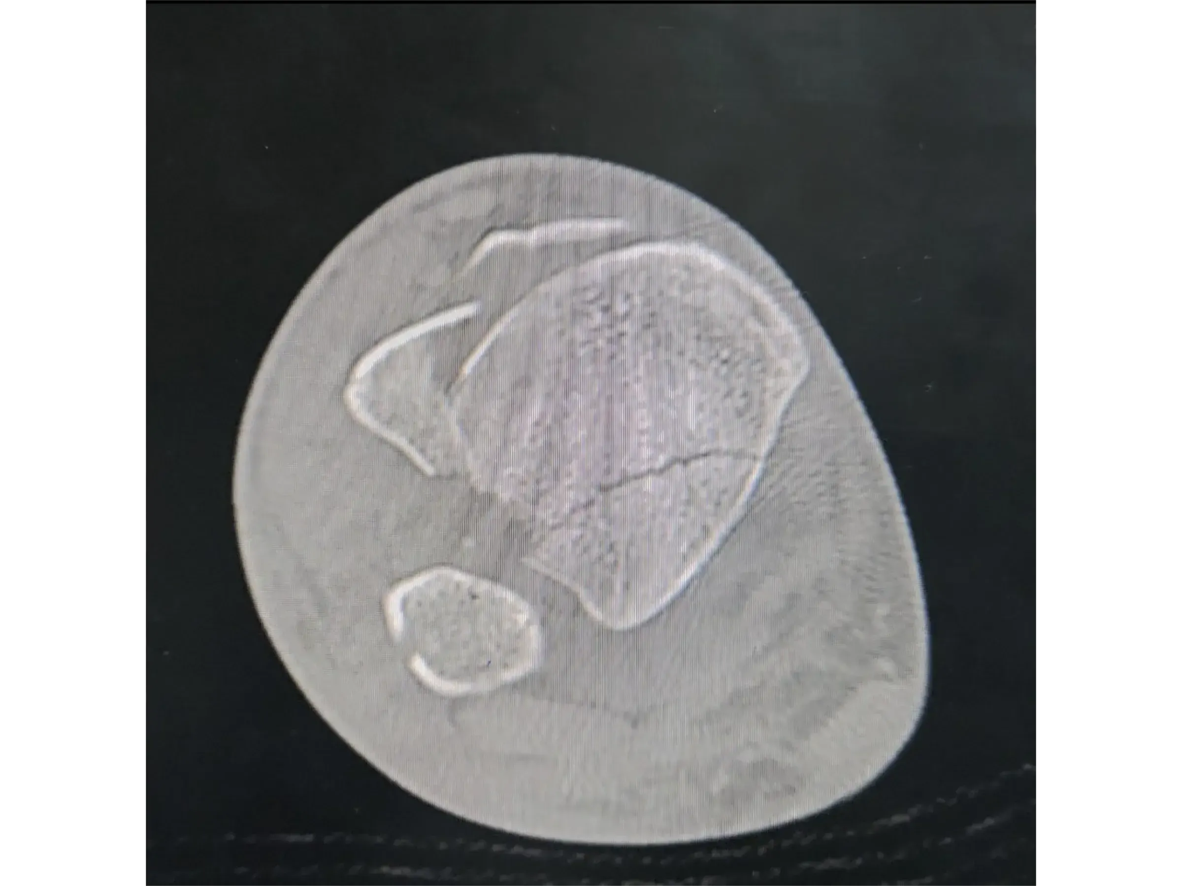 TIBIAL PILON [Case 2] · Posteromedial + Lateral Approach