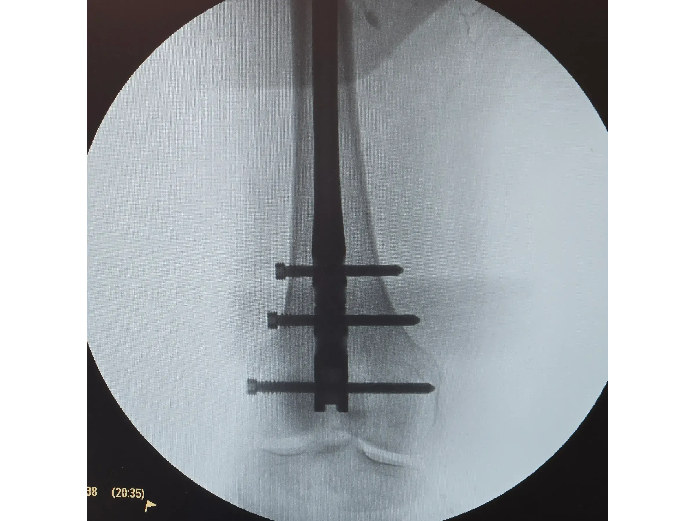 FEMORAL SHAFT [Case 2] · Retrograde Intramedullary Nail