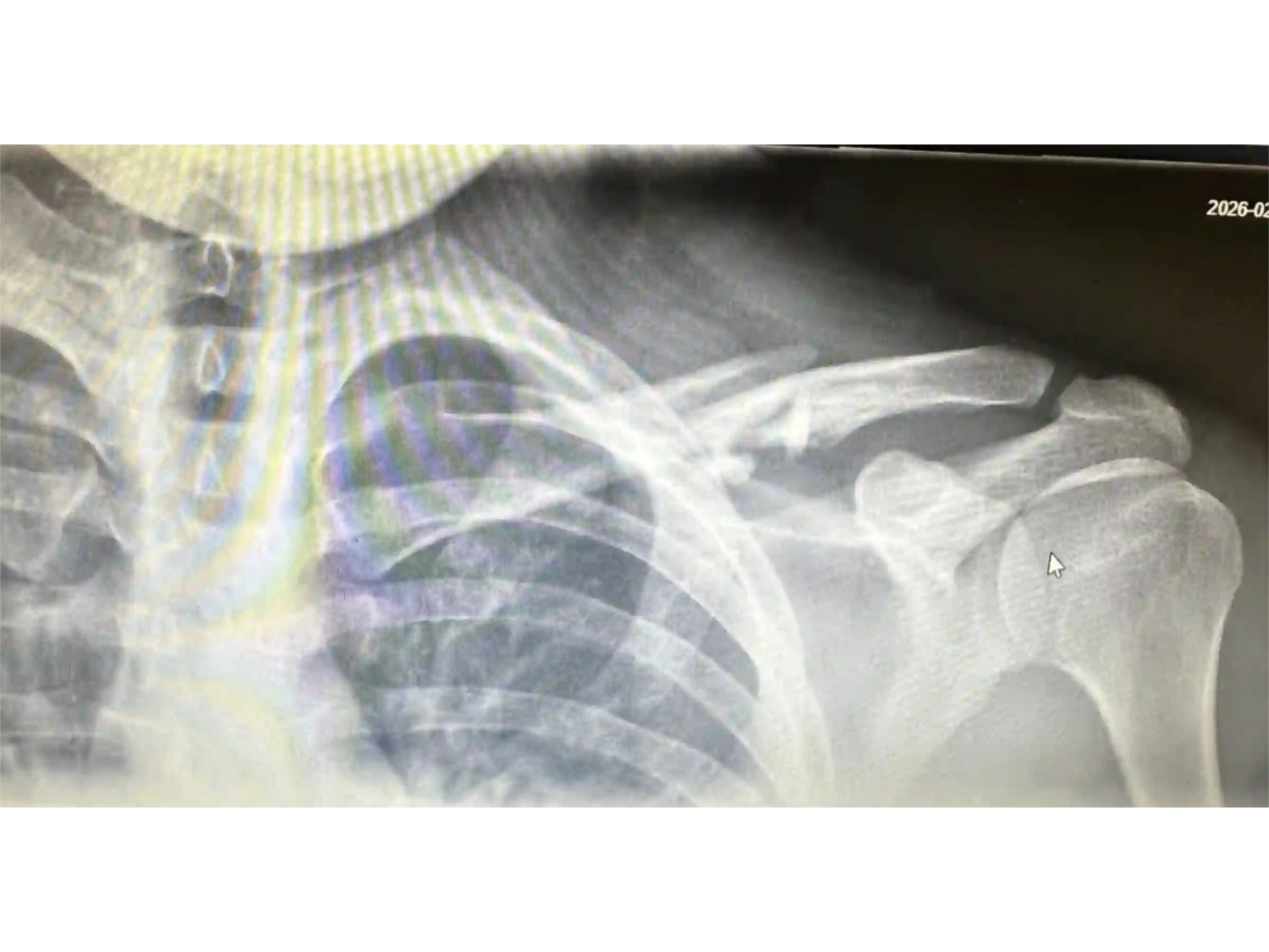 CLAVICLE [CASE 03] Minimally Invasive Percutaneous Osteosynthesis
