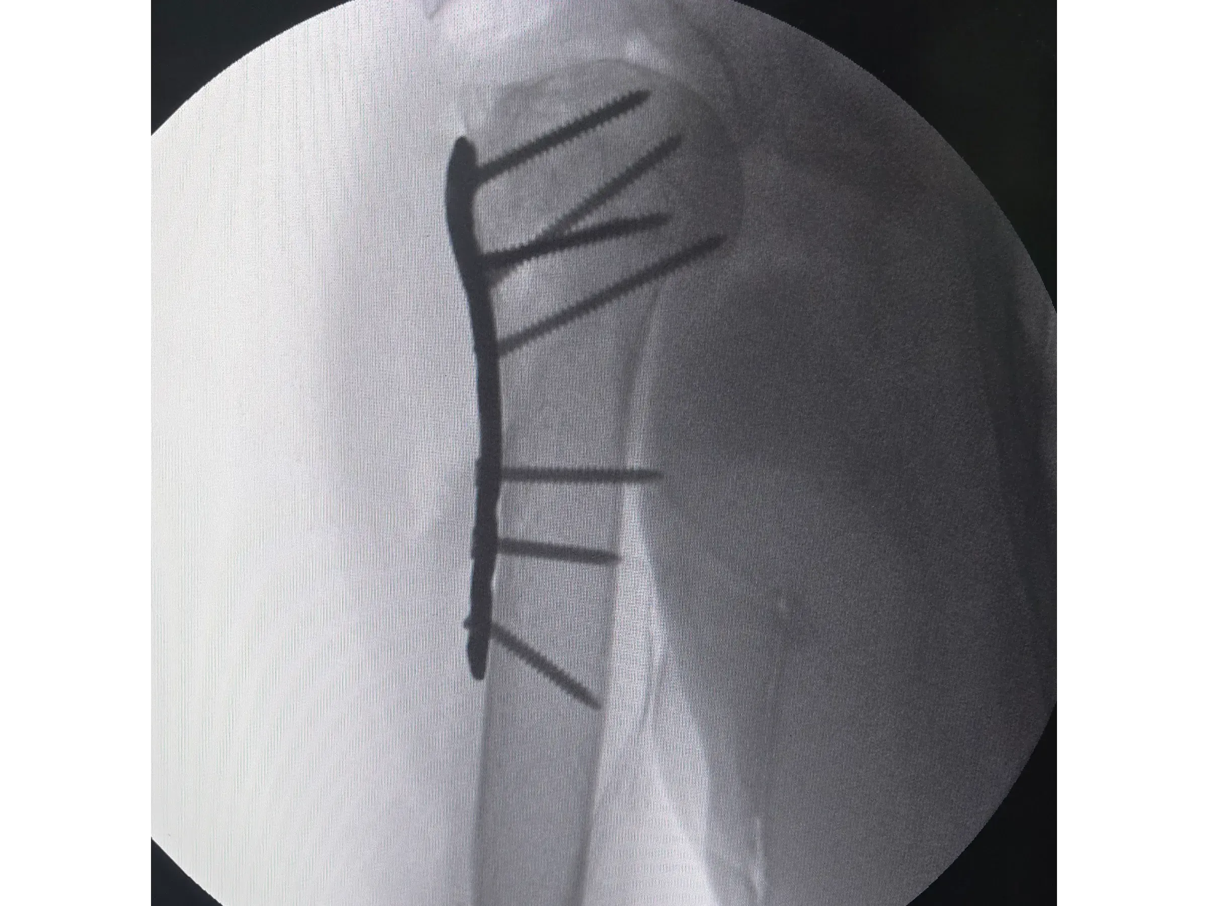 PROXIMAL HUMERUS [Case 6] · Two-Part Fracture · Plate and Screws