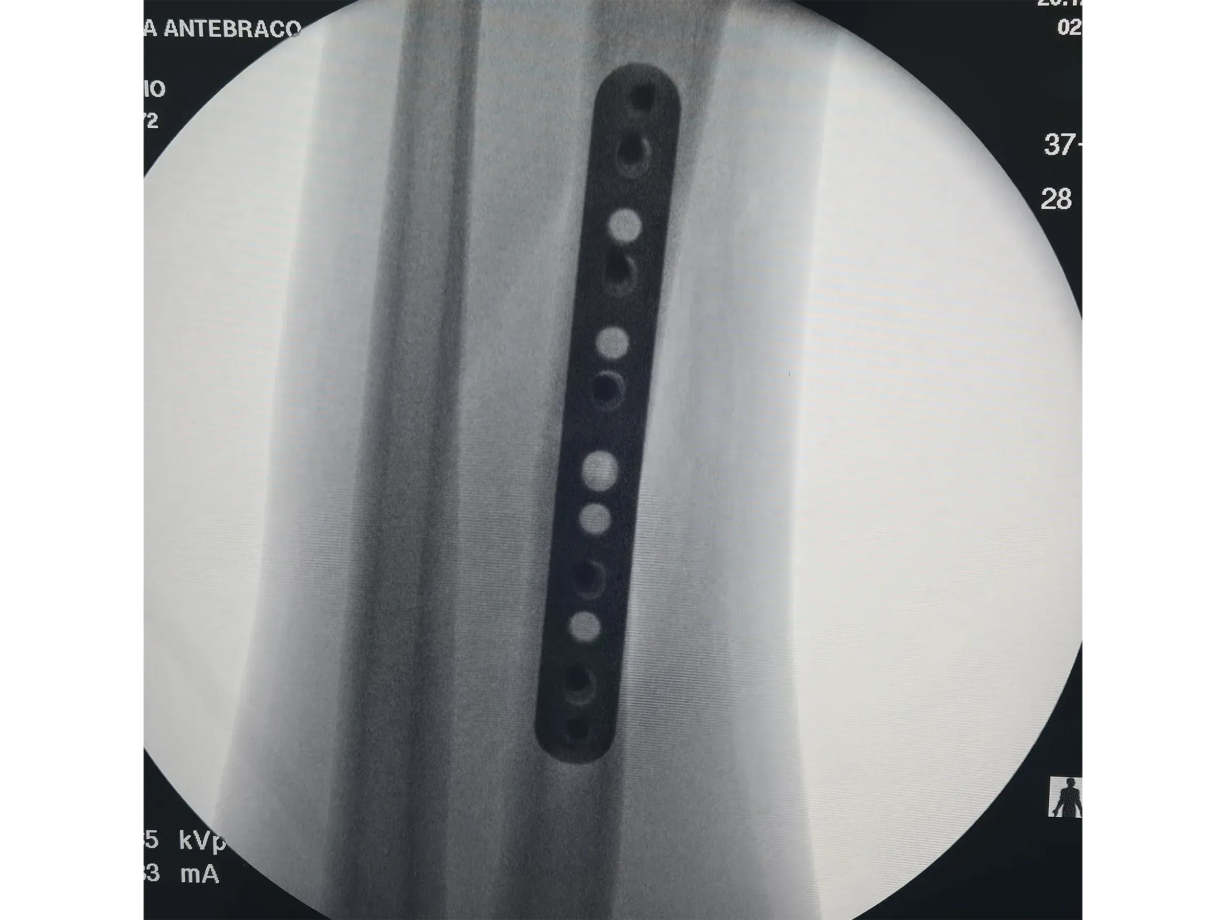 RADIAL SHAFT [Case 2] · Thompson Approach