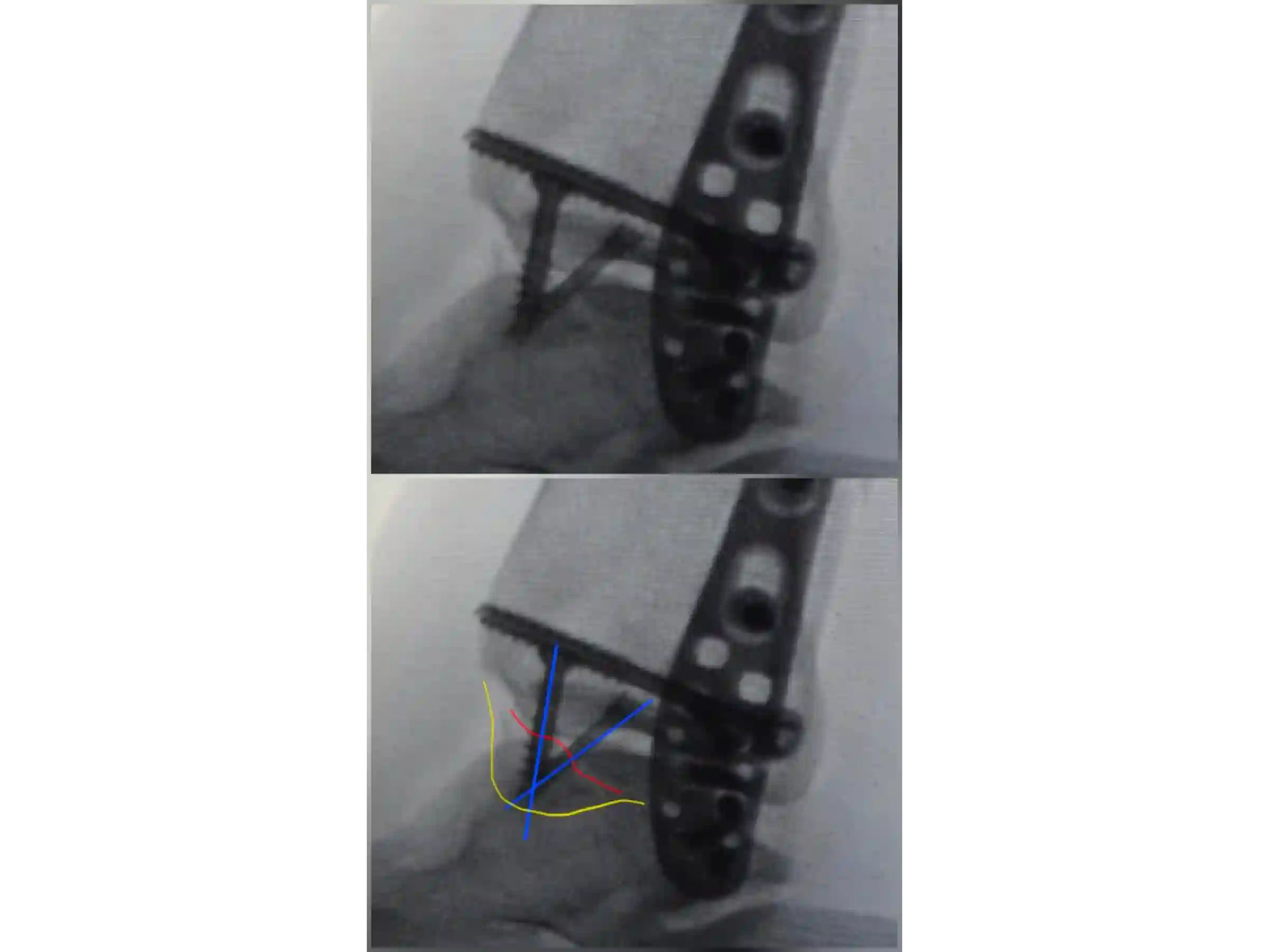 TRIMALLEOLAR [CASE 03] POSTEROLATERAL APPROACH + ANTEGRADE MEDIAL MALLEOLUS FIXATION