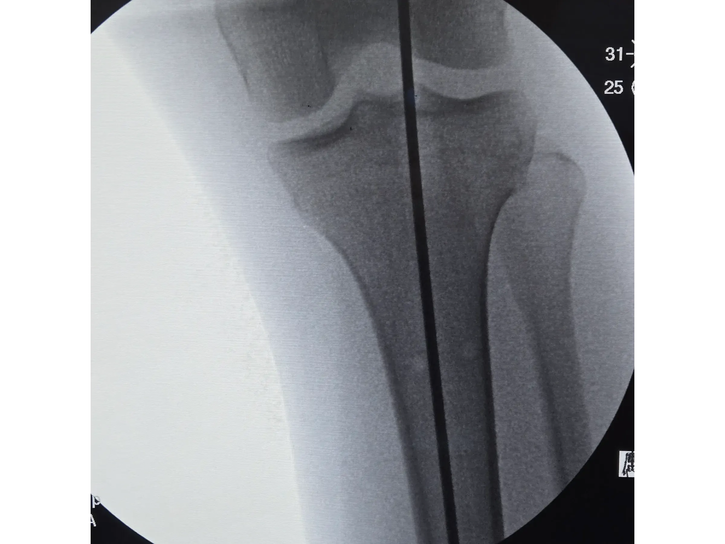 Intramedulläre Tibianagelung – Infrapatellarer Zugang