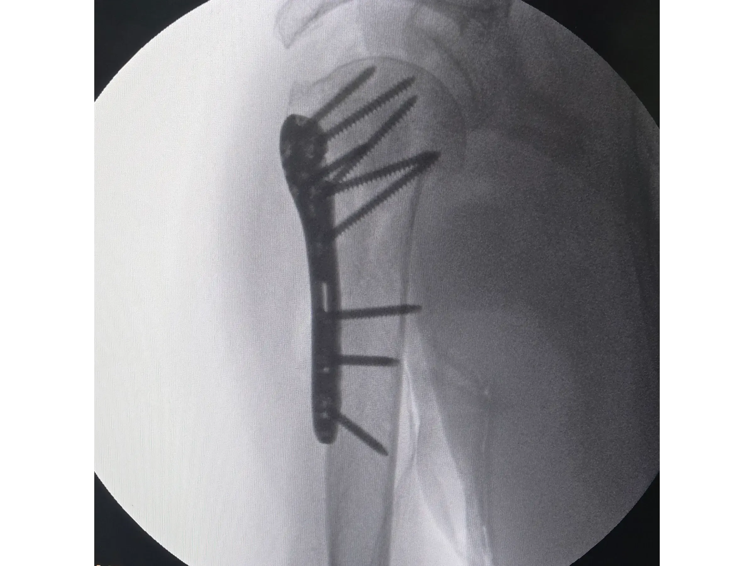 PROXIMAL HUMERUS [Case 6] · Two-Part Fracture · Plate and Screws