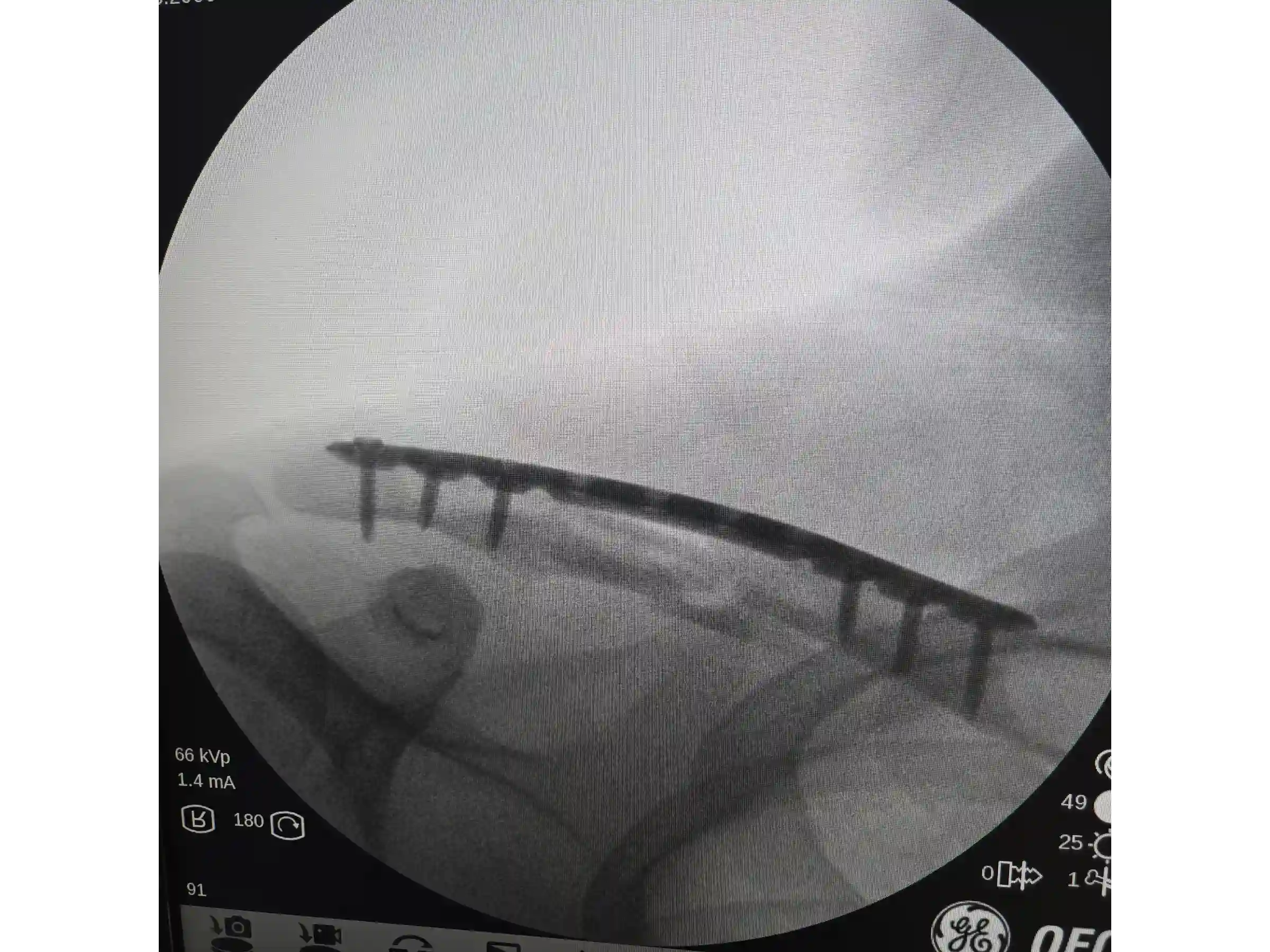 CLAVICLE [CASE 03] Minimally Invasive Percutaneous Osteosynthesis