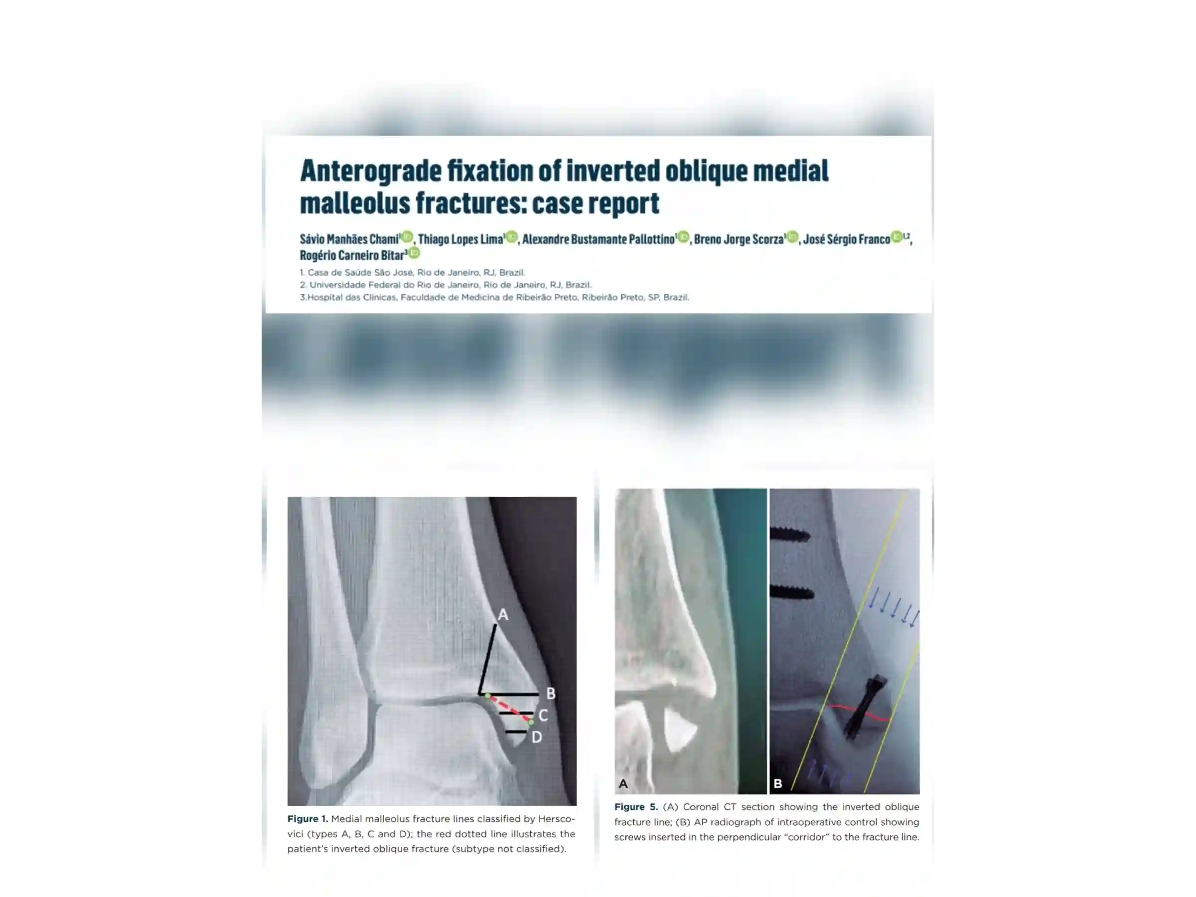 TRIMALLEOLAR [CASE 03] POSTEROLATERAL APPROACH + ANTEGRADE MEDIAL MALLEOLUS FIXATION