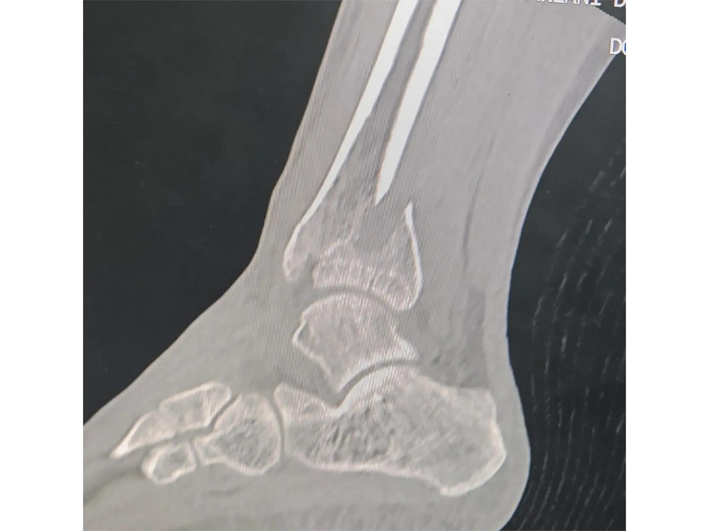 TIBIAL PILON [Case 2] · Posteromedial + Lateral Approach