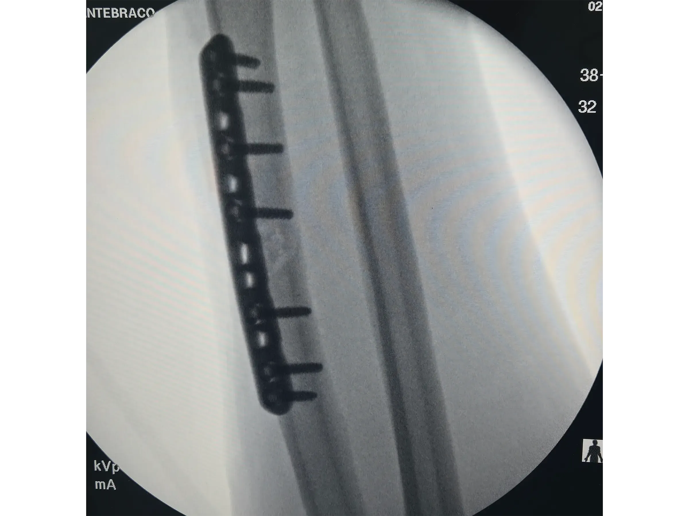RADIAL SHAFT [Case 2] · Thompson Approach
