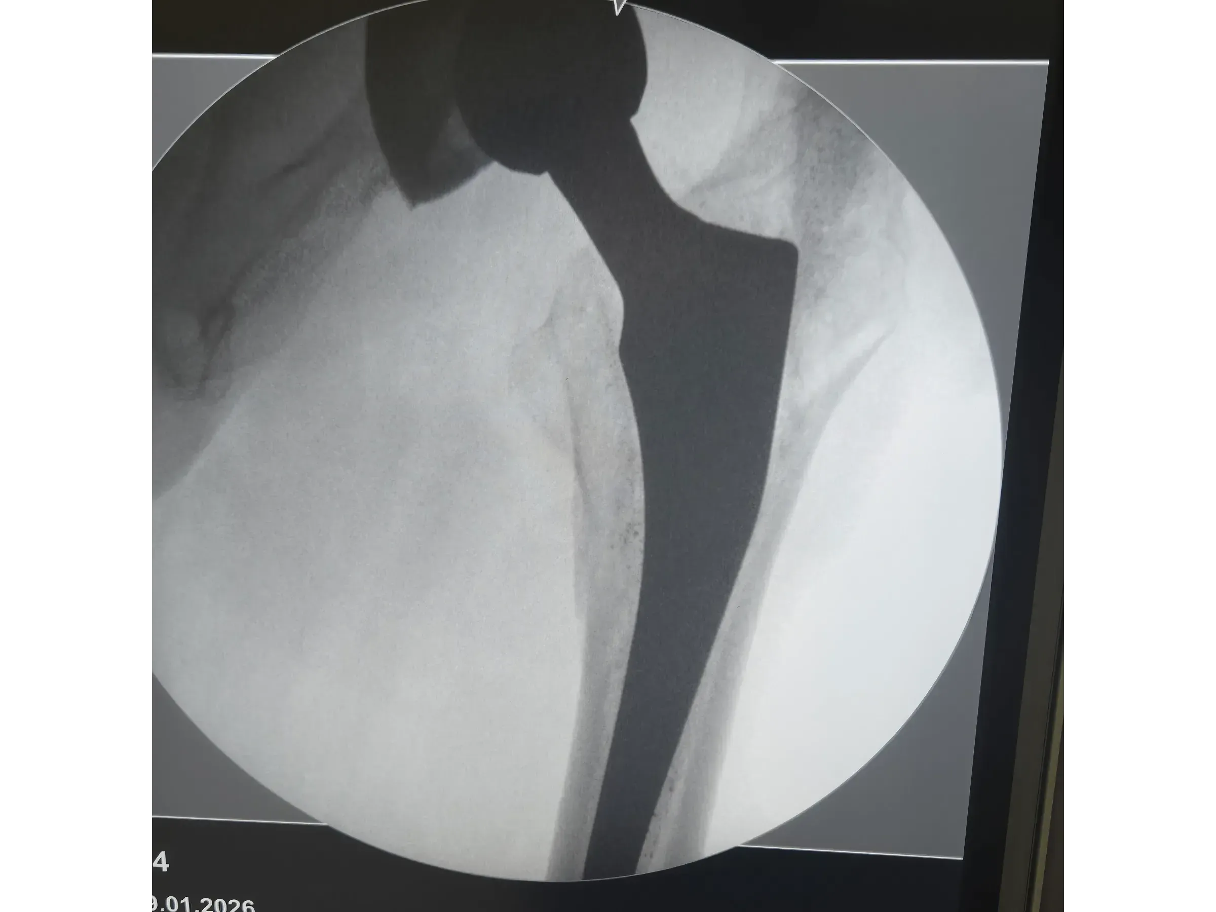 PERIPROSTHETIC HIP FRACTURE [Case 1] · Trochanteric Plate + Cerclage