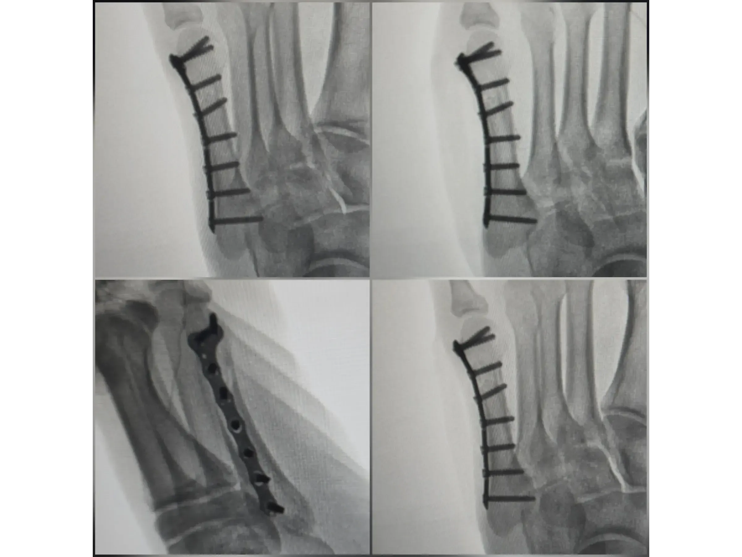 FIFTH METATARSAL [Case 2] · Mini-fragment Plate and Screws
