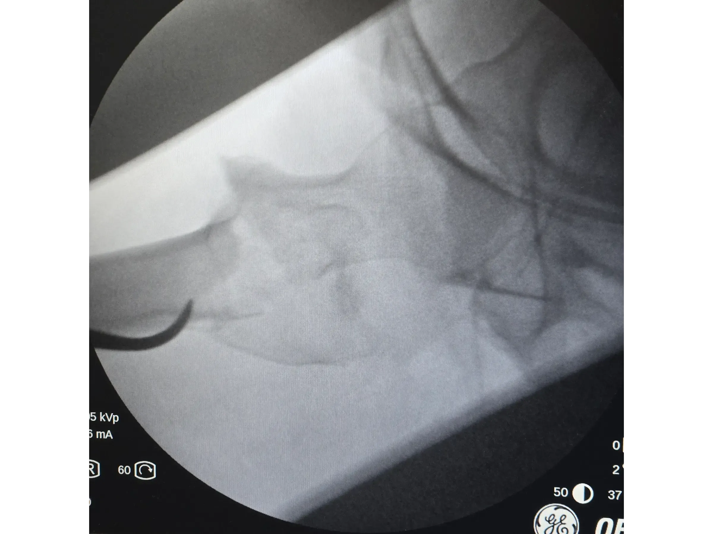 PROXIMALER FEMUR [Fall 4] · Doppel-Wippen-Technik