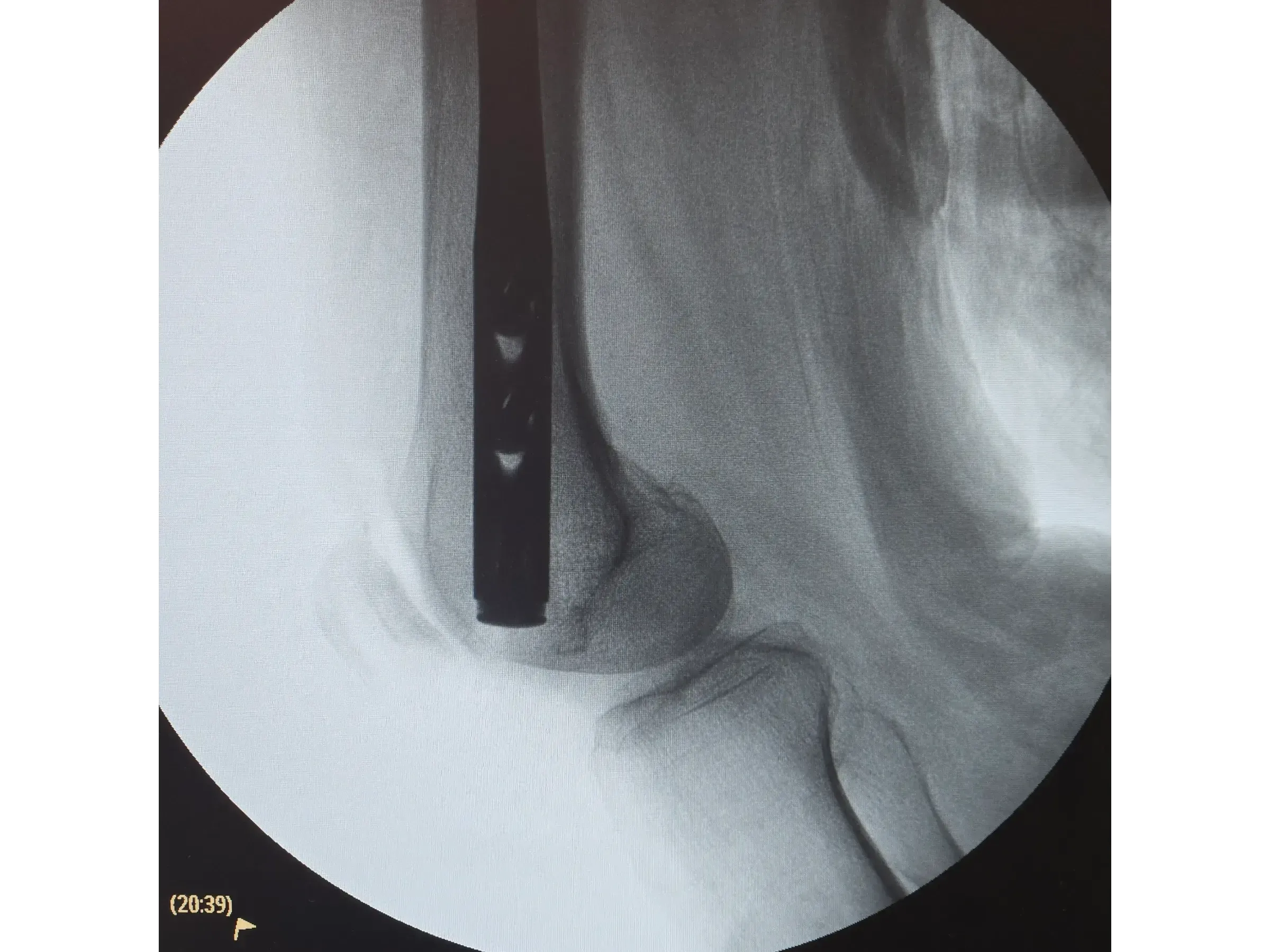 FEMORAL SHAFT [Case 2] · Retrograde Intramedullary Nail