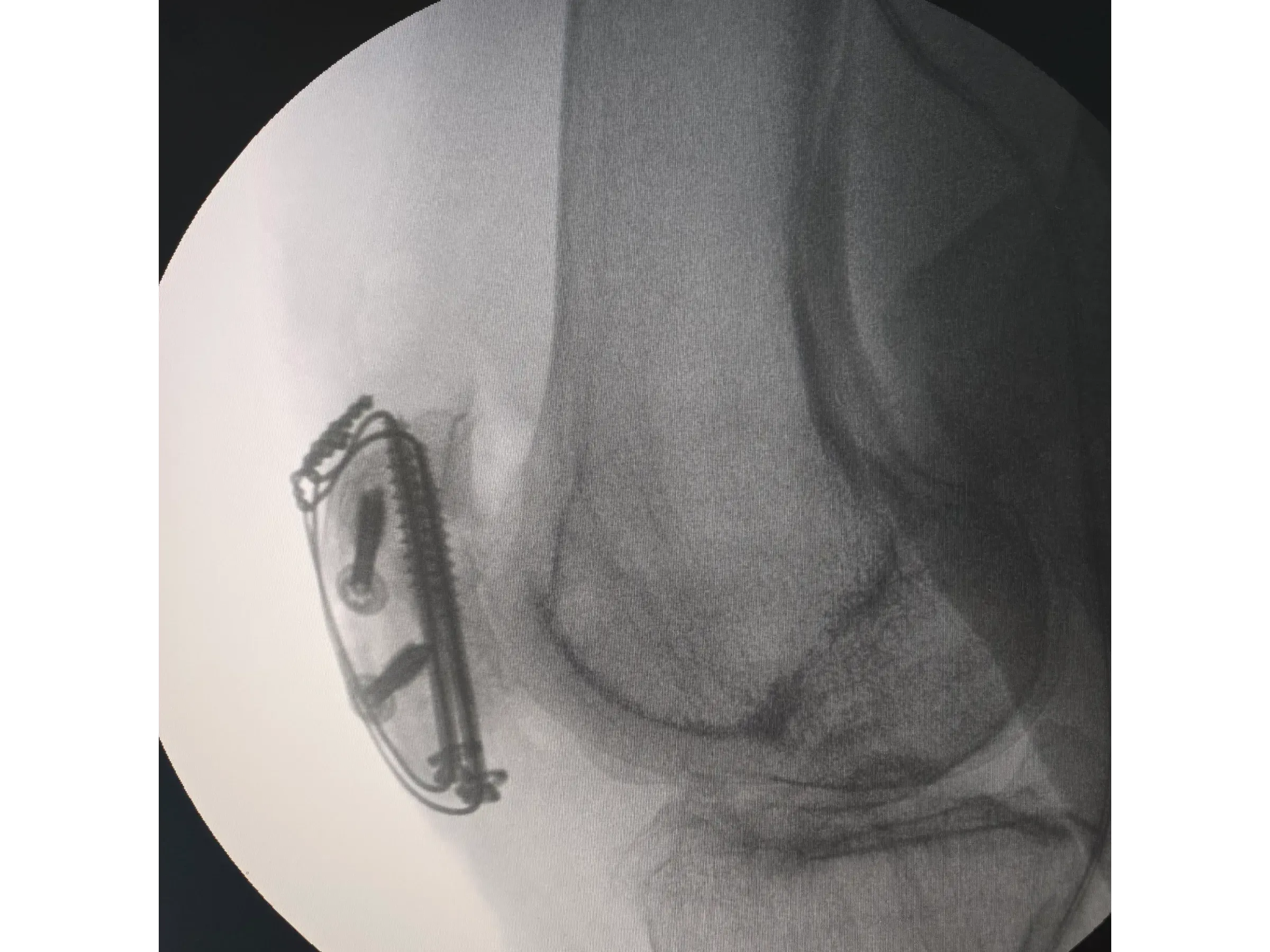 PATELLA [Case 2] · Cannulated Screws + Cerclage