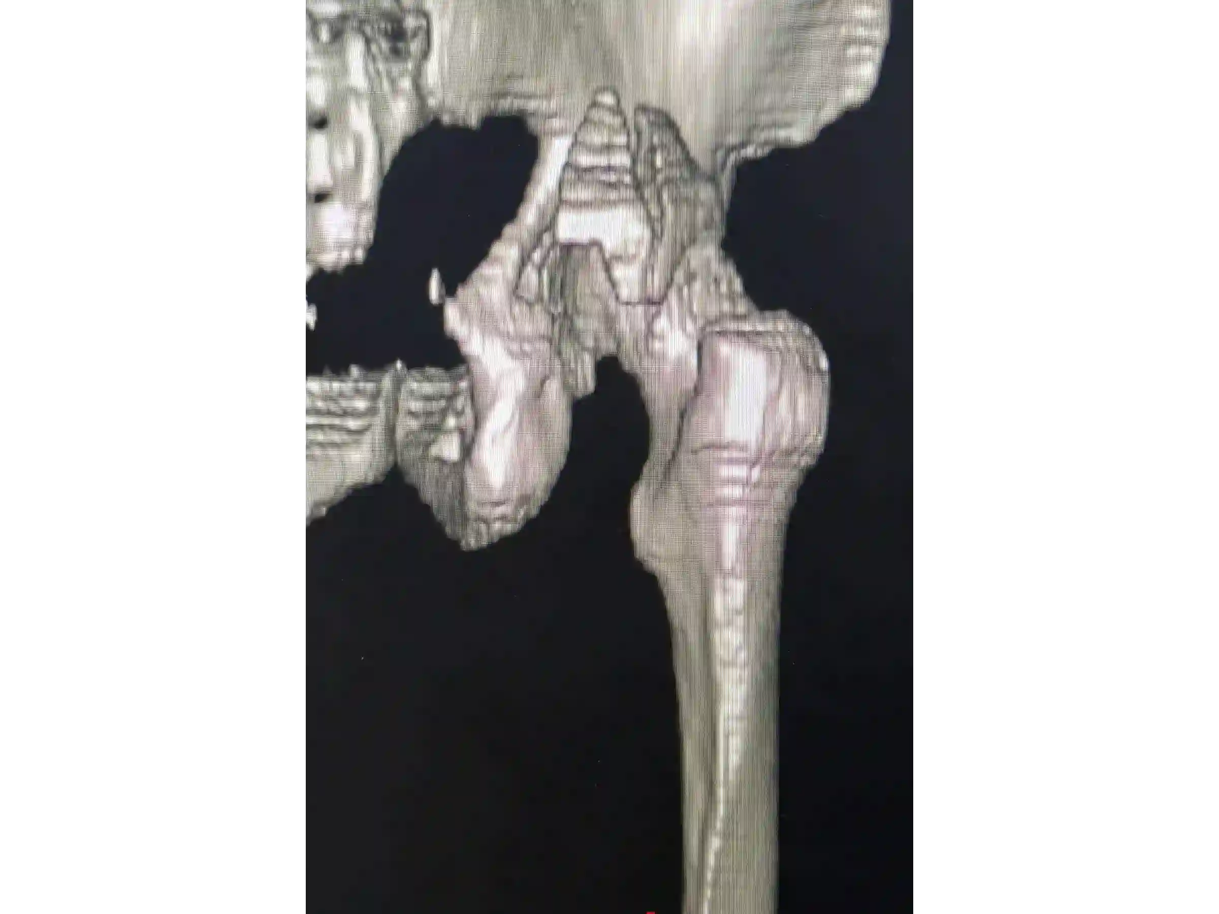 ACETABULUM [FALL 02] · Hinterer Rand + Gelenkimpaktion