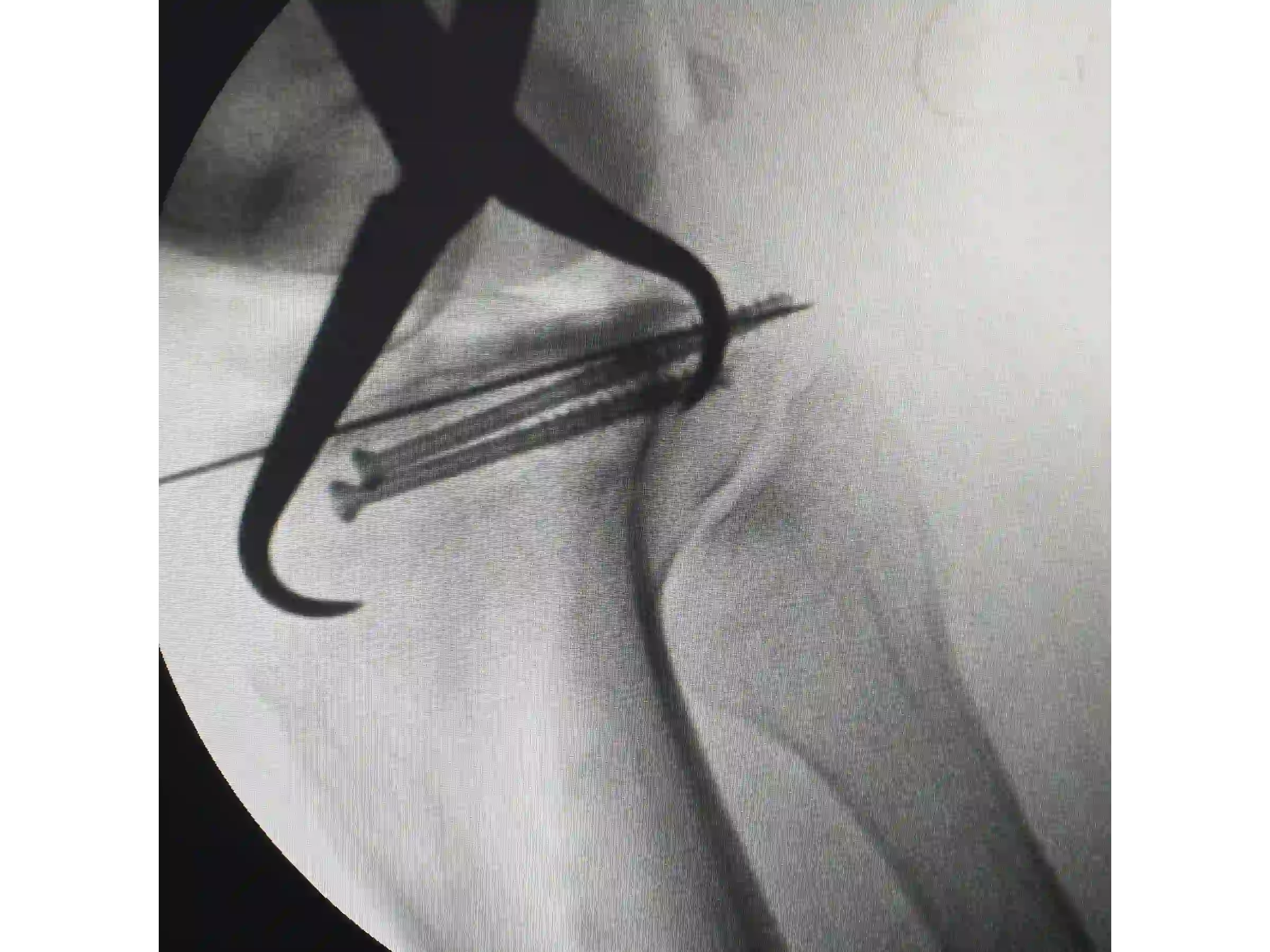 TIBIAL PLATEAU [CASE 03] Posterolateral Depression