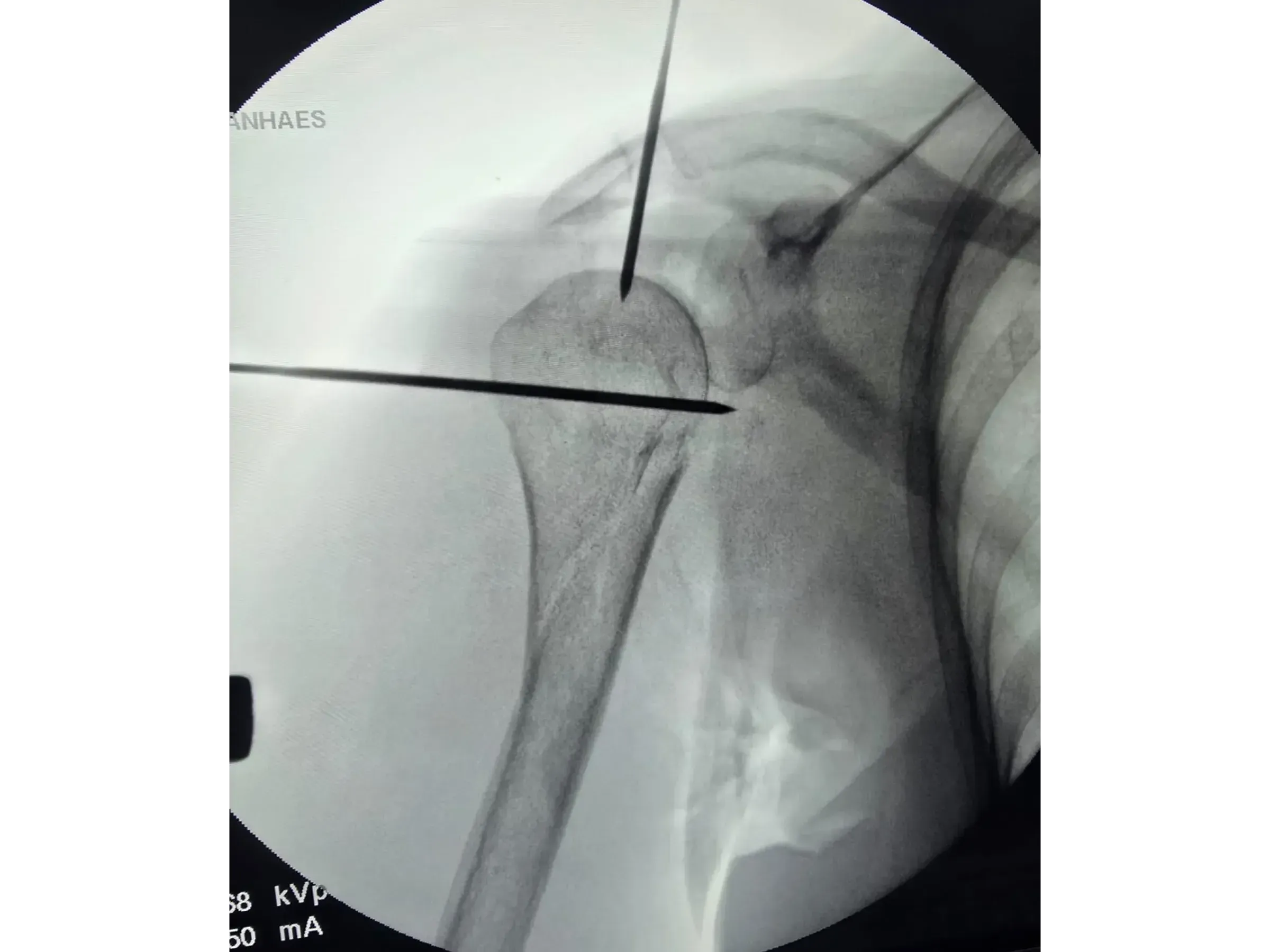 Intramedullärer Nagel für den proximalen Humerus (03)