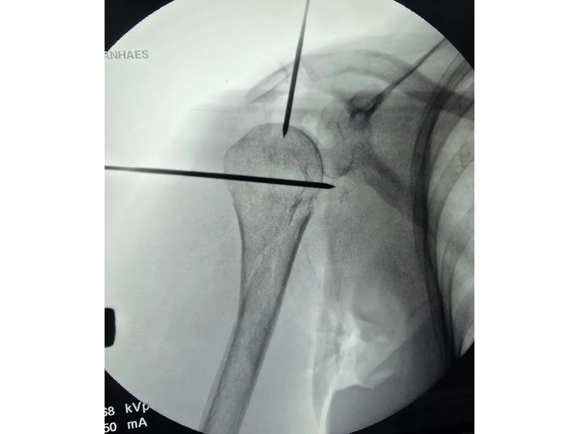 Intramedullärer Nagel für den proximalen Humerus