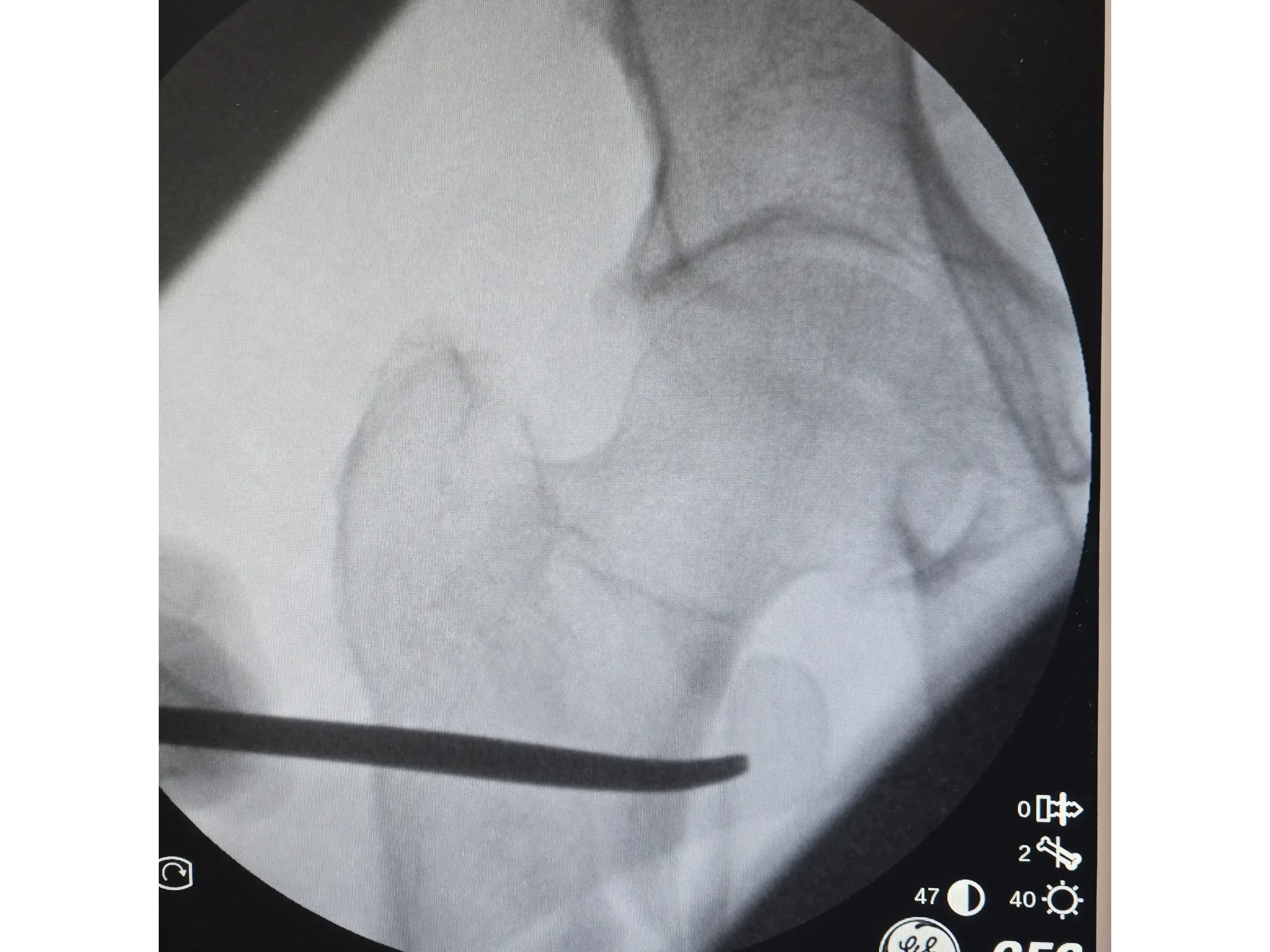 PROXIMALER FEMUR [Fall 4] · Doppel-Wippen-Technik