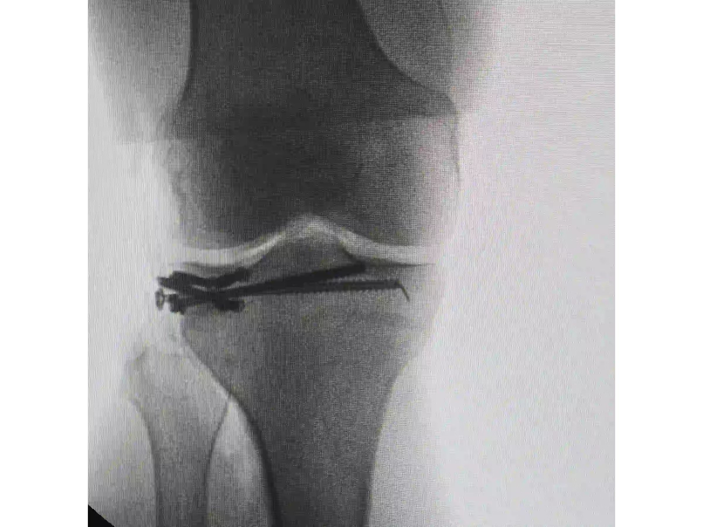 TIBIAL PLATEAU [CASE 03] Posterolateral Depression