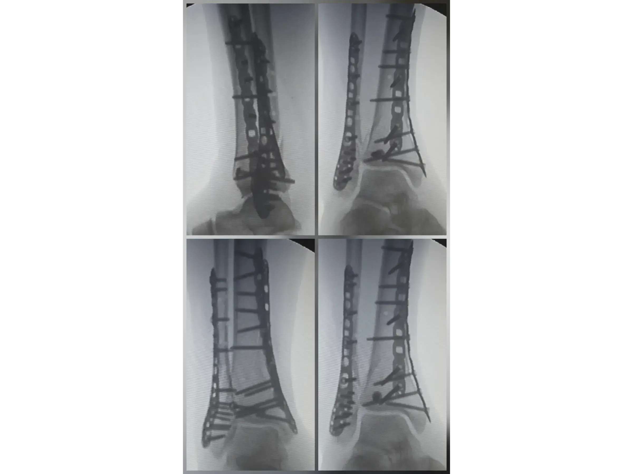 TIBIAL PILON [Case 2] · Posteromedial + Lateral Approach