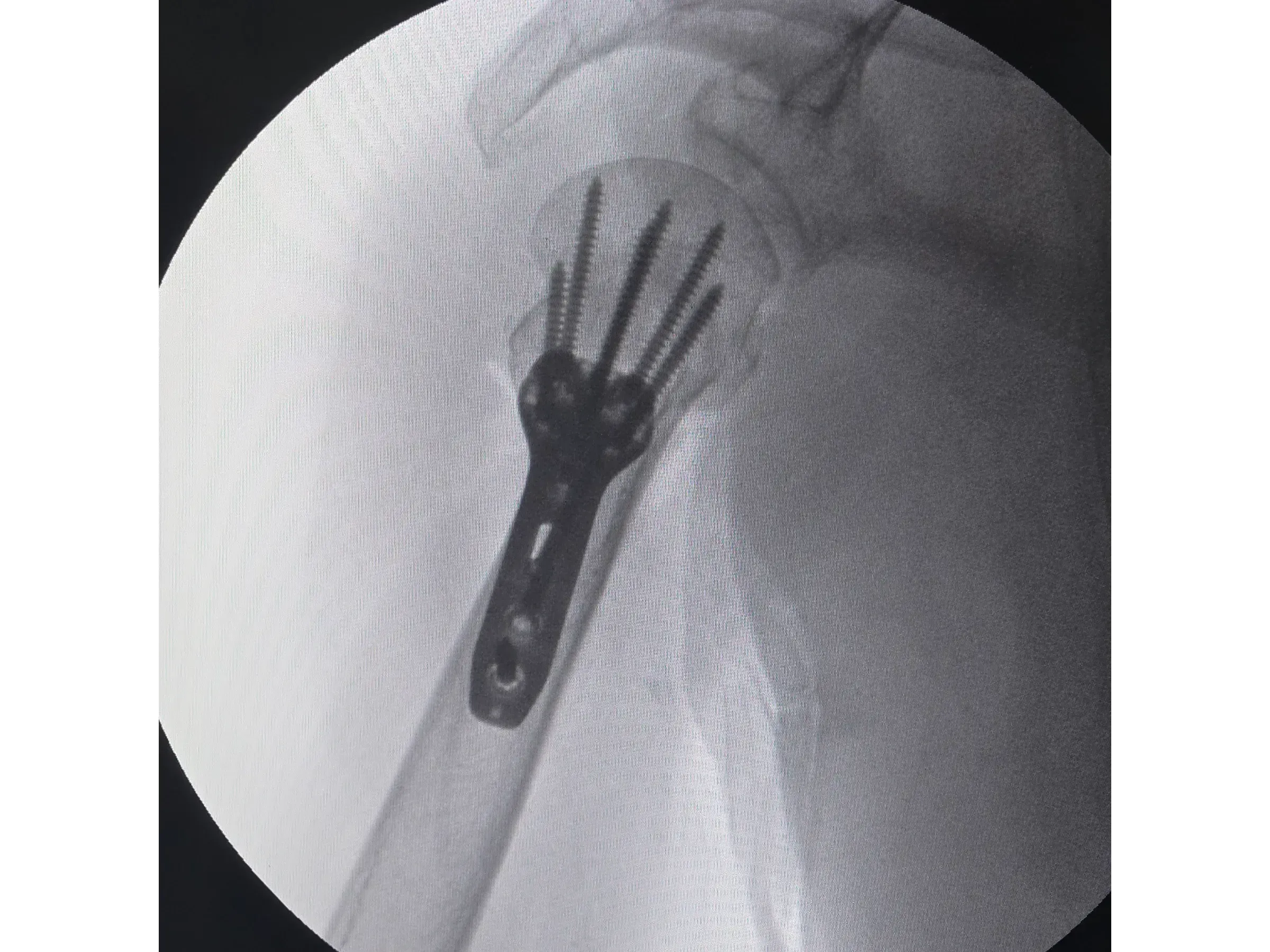PROXIMAL HUMERUS [Case 6] · Two-Part Fracture · Plate and Screws