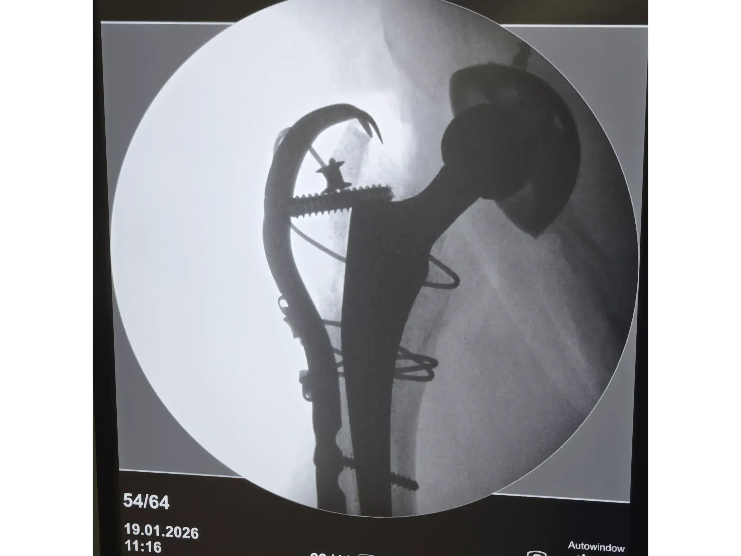 PERIPROSTHETIC HIP FRACTURE [Case 1] · Trochanteric Plate + Cerclage