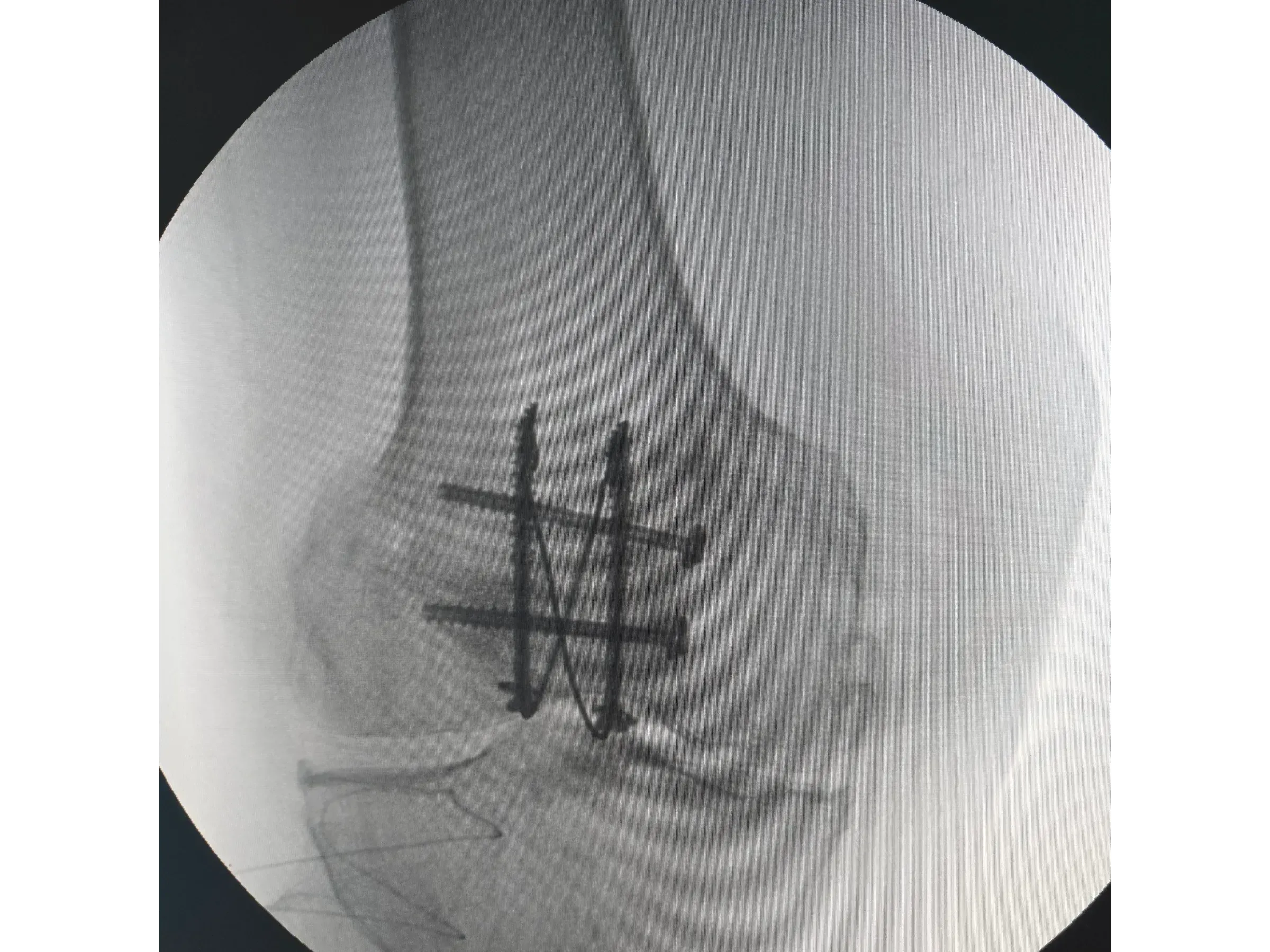PATELLA [Case 2] · Cannulated Screws + Cerclage