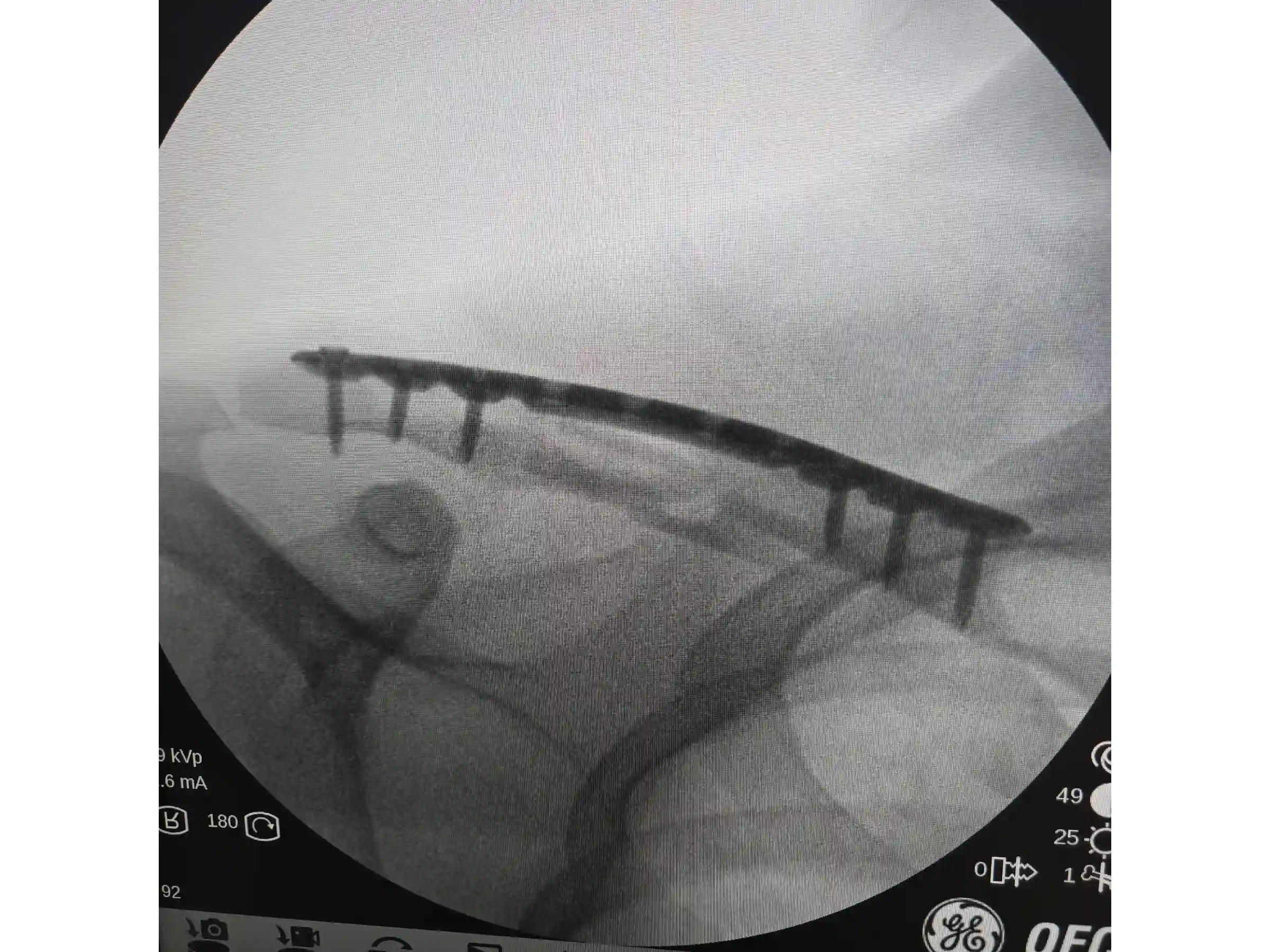CLAVICLE [CASE 03] Minimally Invasive Percutaneous Osteosynthesis