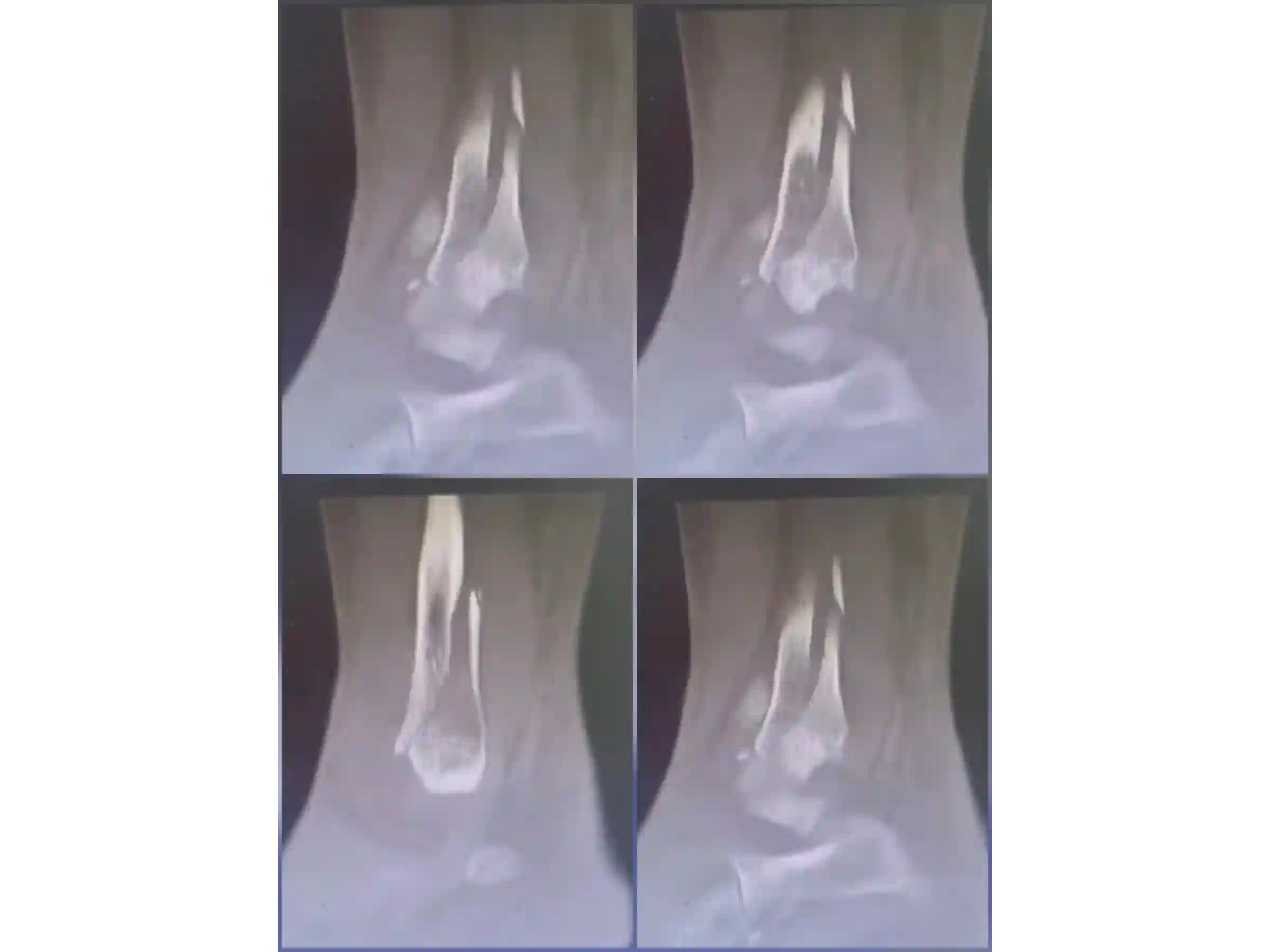 TRIMALLEOLAR [CASE 03] POSTEROLATERAL APPROACH + ANTEGRADE MEDIAL MALLEOLUS FIXATION