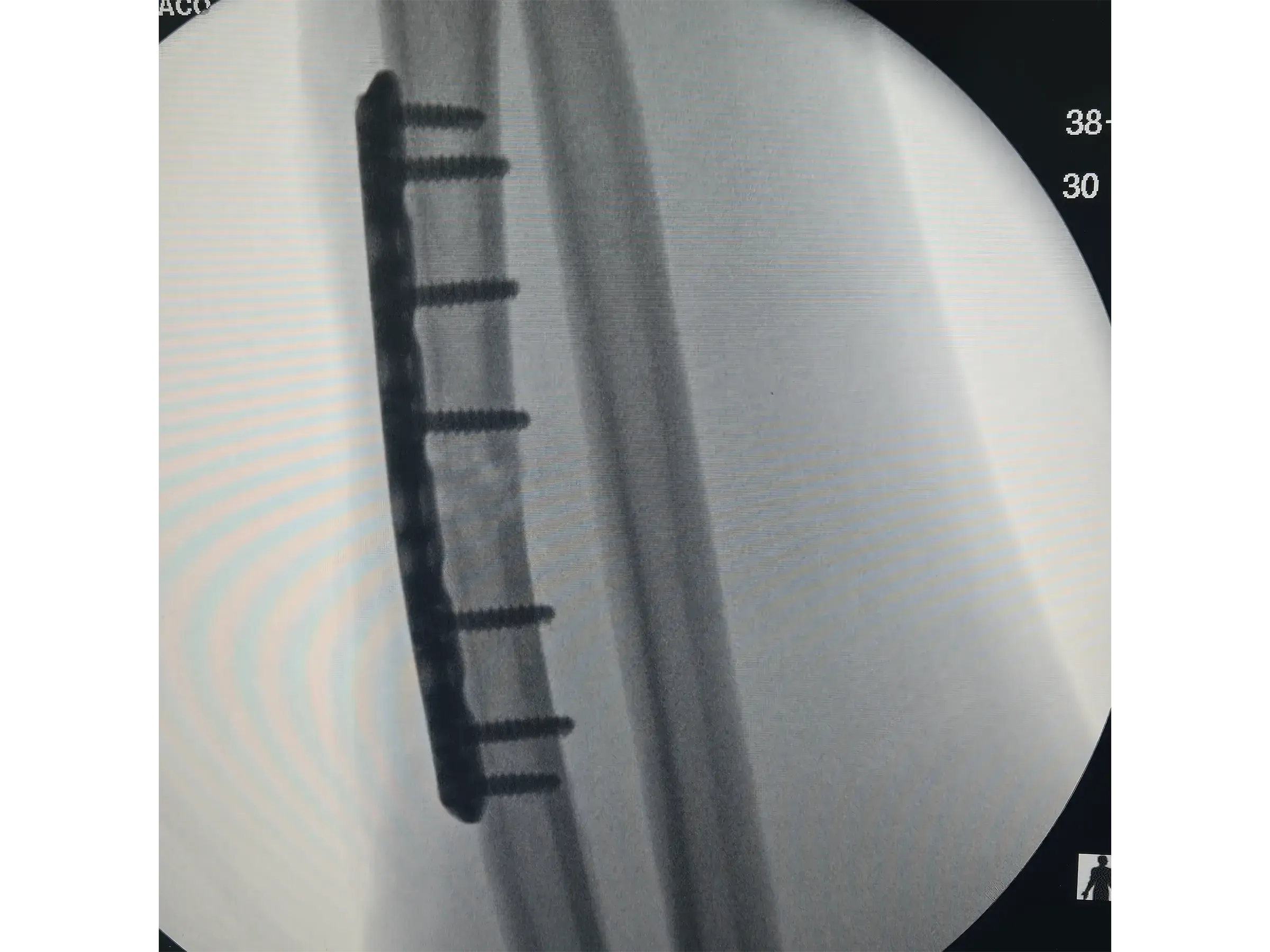 RADIAL SHAFT [Case 2] · Thompson Approach
